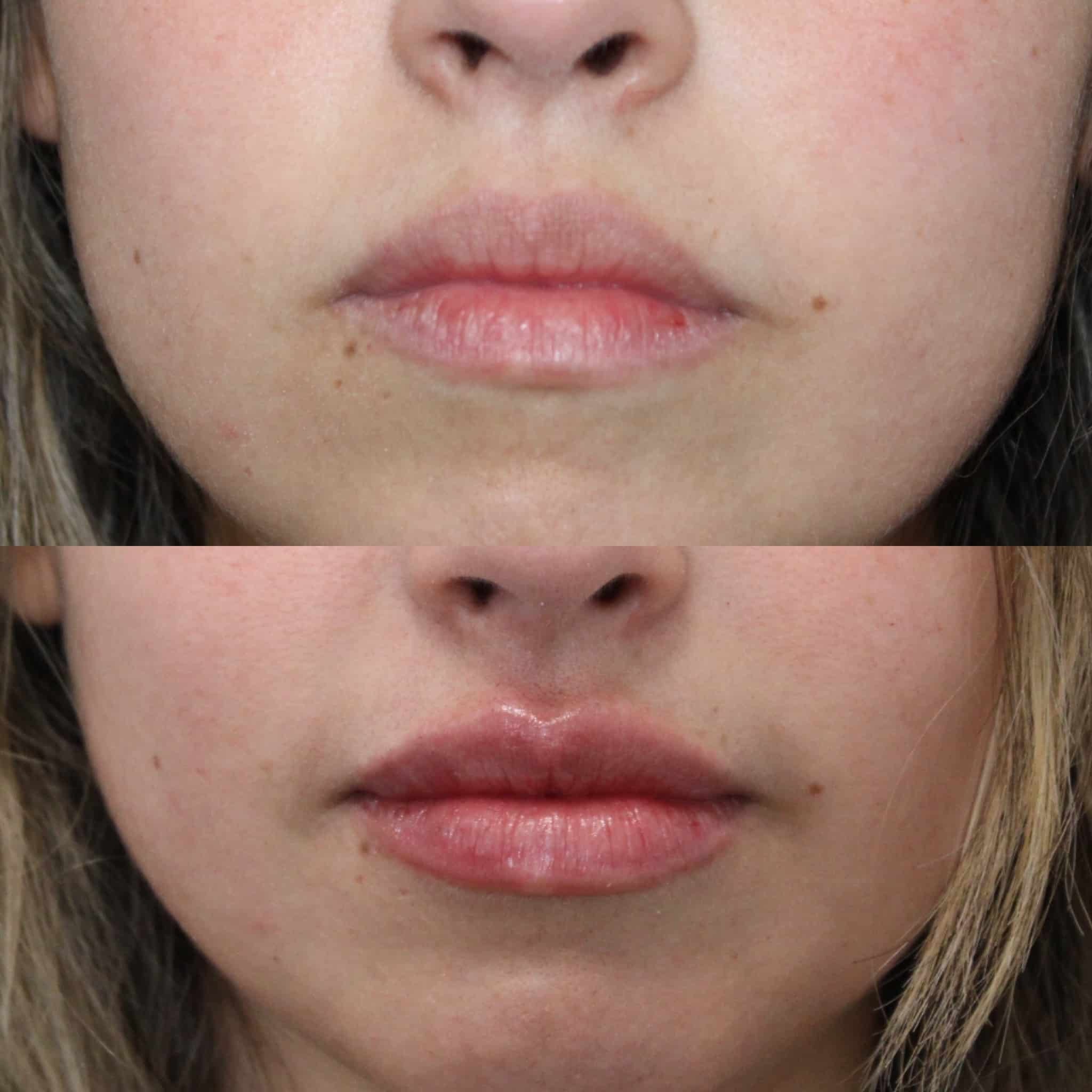 Antes y después de ácido hialurónico en labios, Barcelona, paciente 1