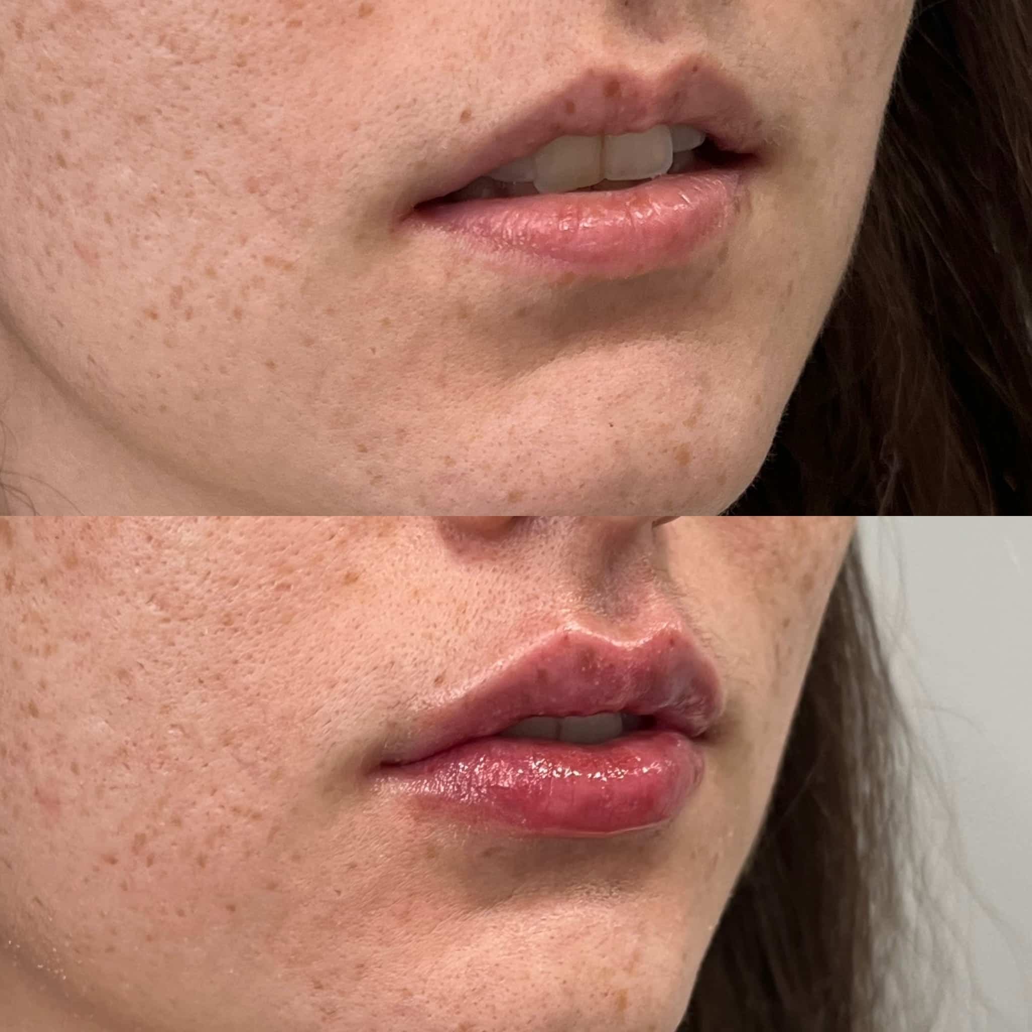 Antes y después de ácido hialurónico en labios, Barcelona, paciente 2