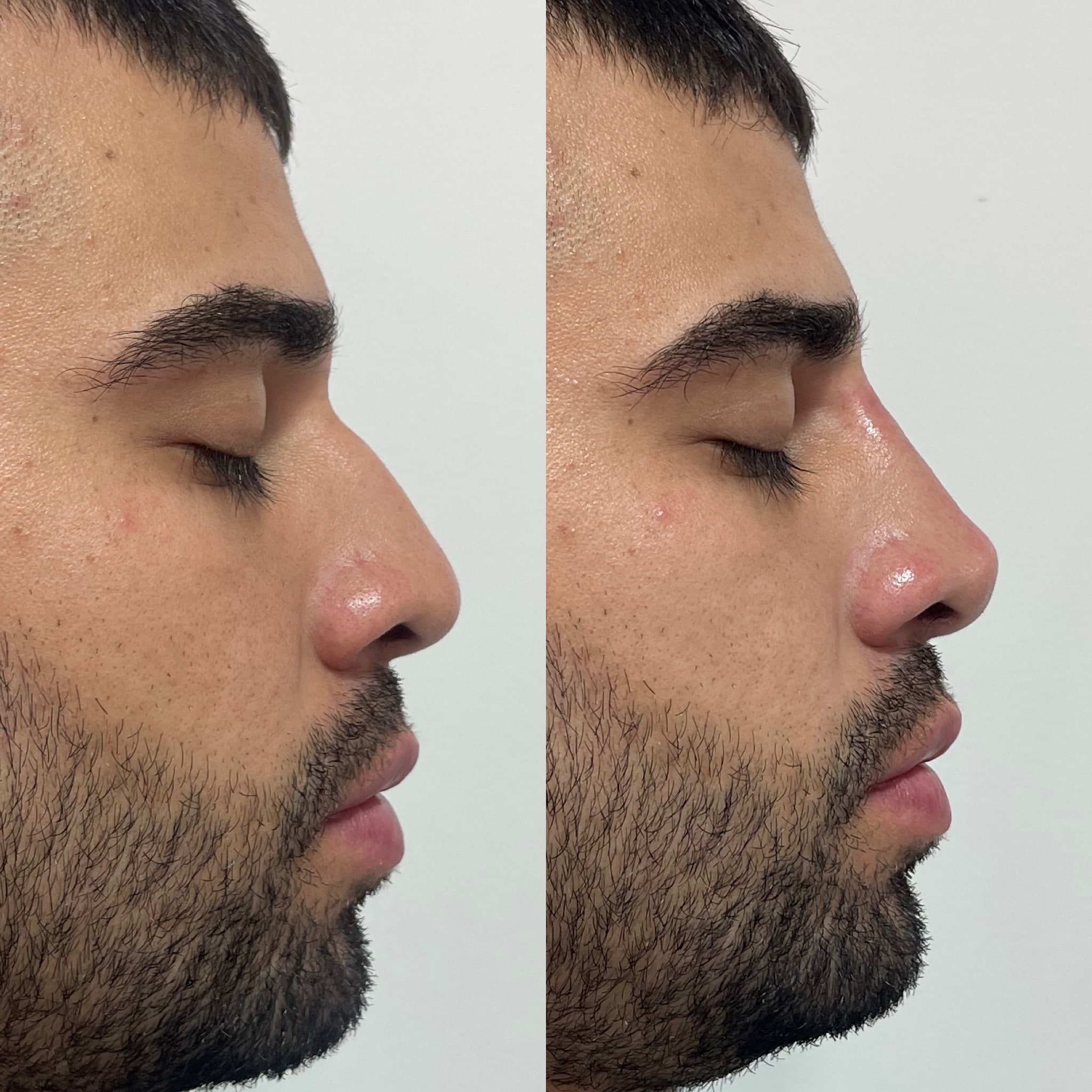 Antes y después de rinomodelación con ácido hialurónico en Barcelona, paciente 4