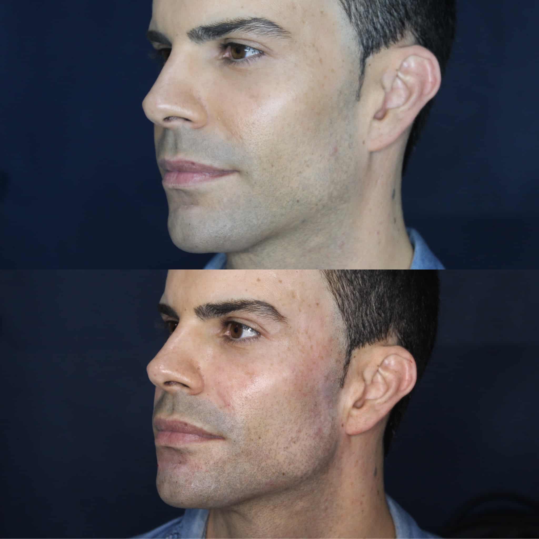 Masculinización facial con ácido hialurónico en Barcelona