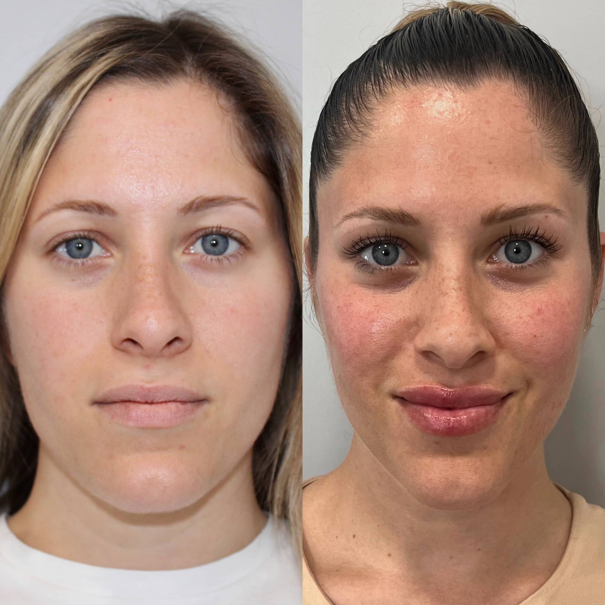 Antes y después de ácido hialurónico facial en Barcelona, paciente 6