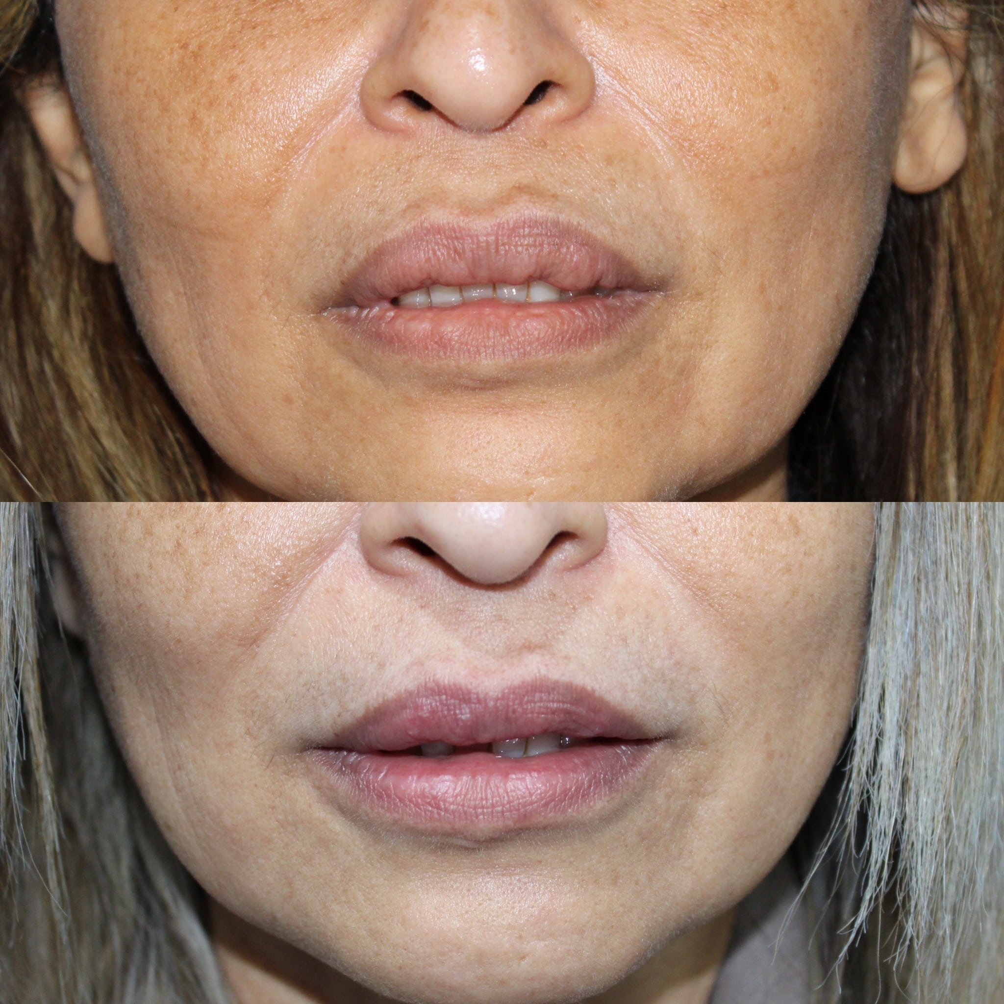 Antes y después de queiloplastia en Barcelona, paciente 1