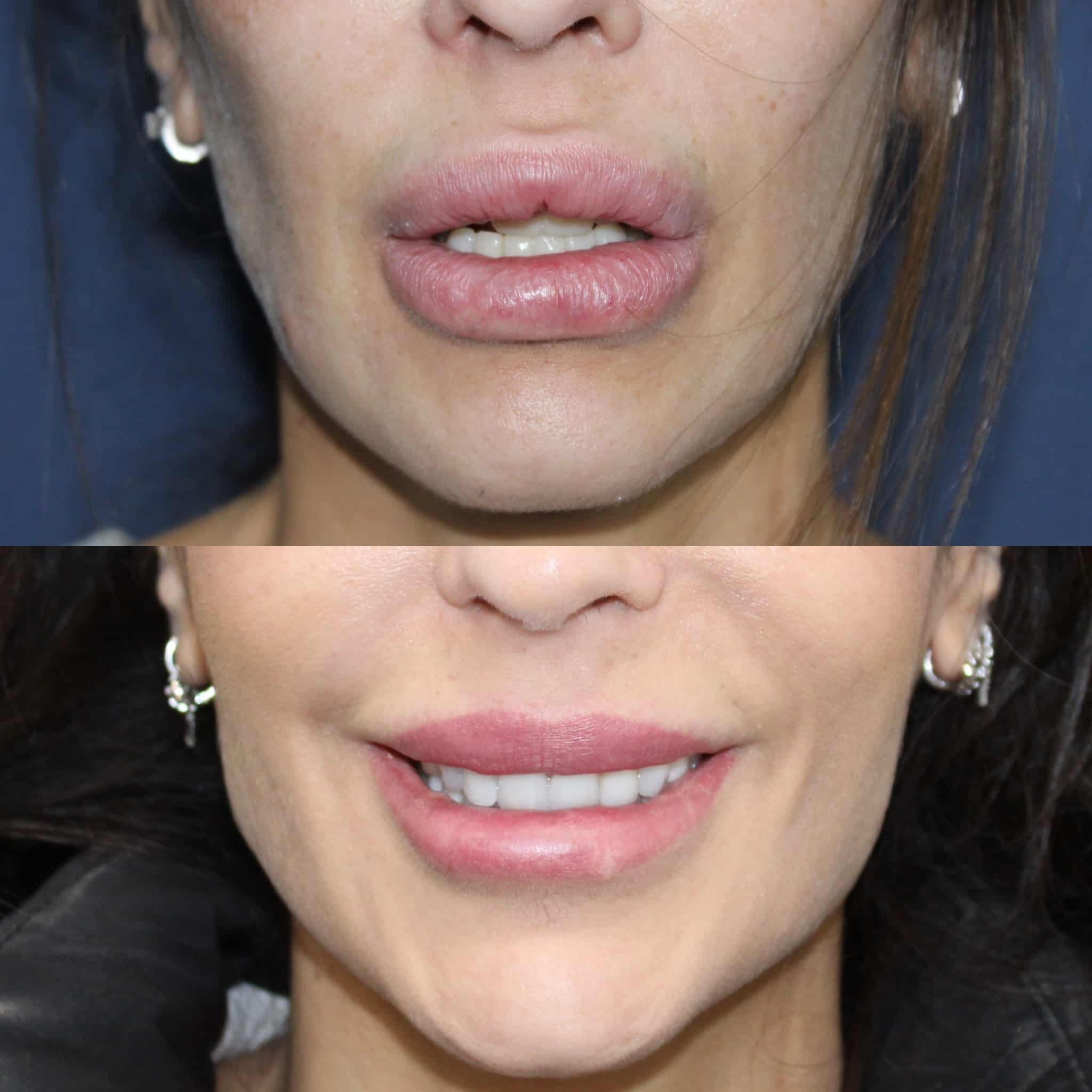 Antes y después de queiloplastia en Barcelona, paciente 2