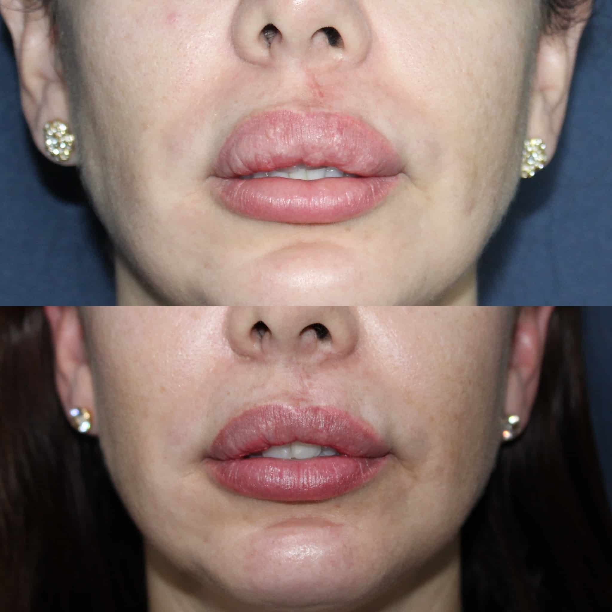 Antes y después de queiloplastia en Barcelona, paciente 3
