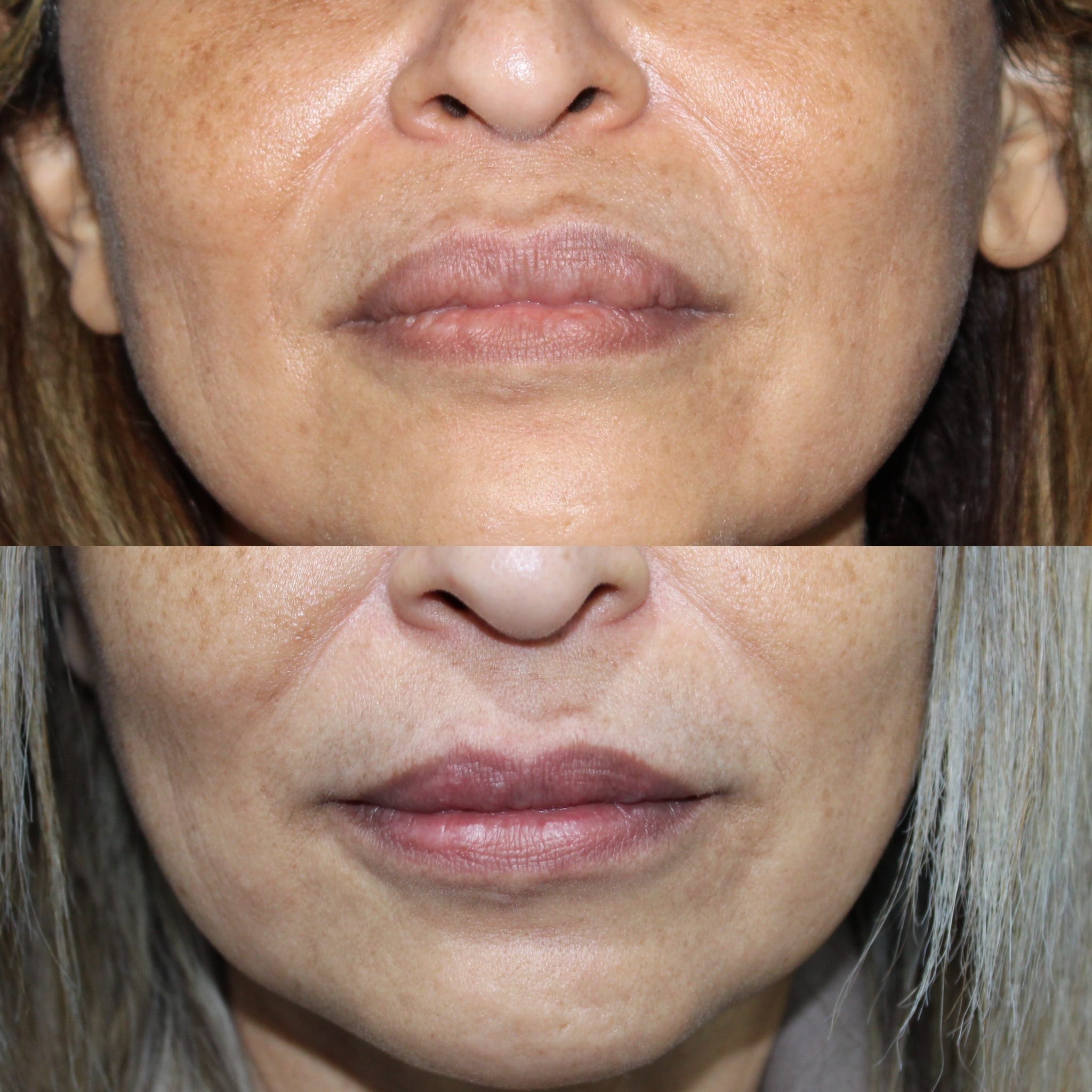 Antes y después de queiloplastia en Barcelona, paciente 5