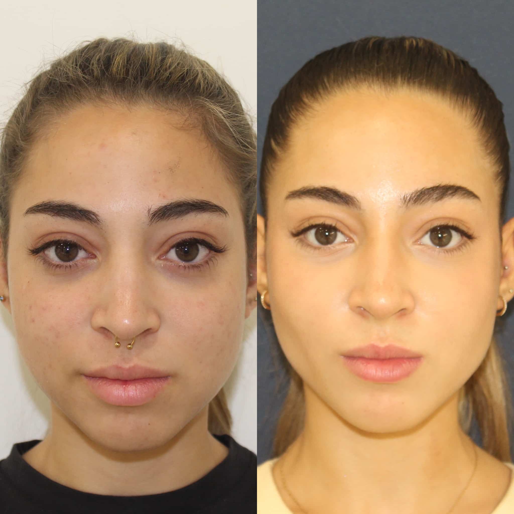 Antes y después de bichectomía en Barcelona, paciente 1