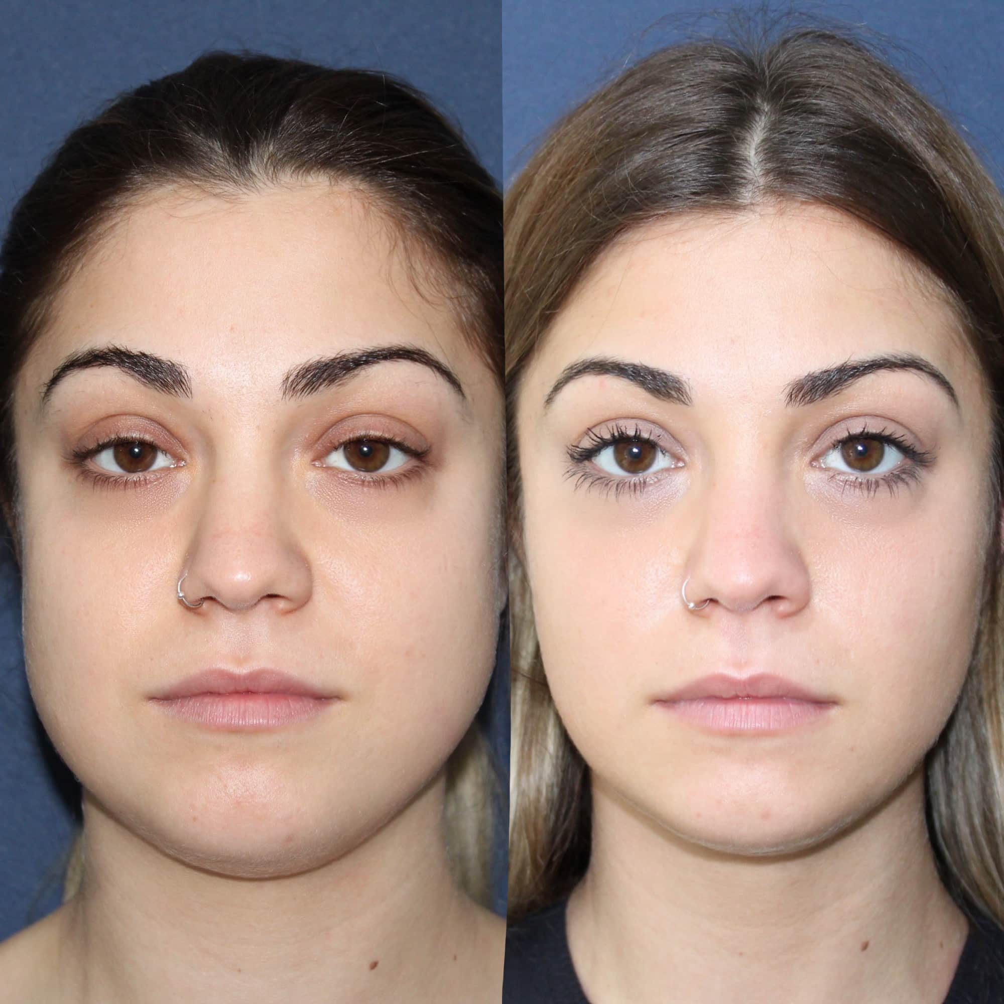 Antes y después de bichectomía en Barcelona, paciente 2
