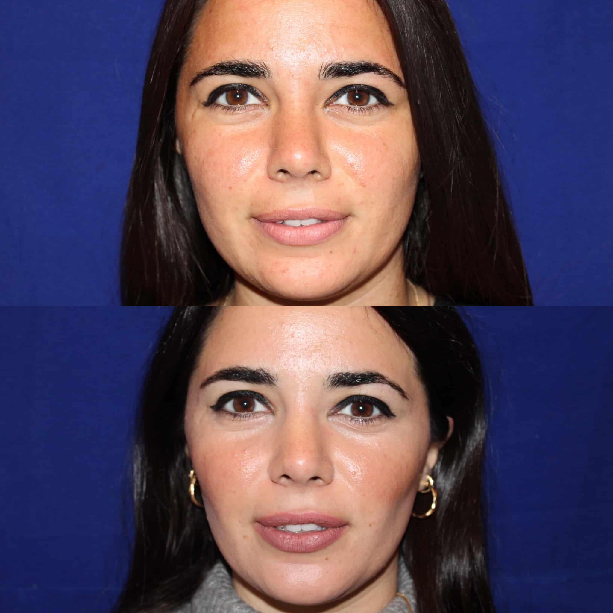 Antes y después de bichectomía en Barcelona, paciente 4