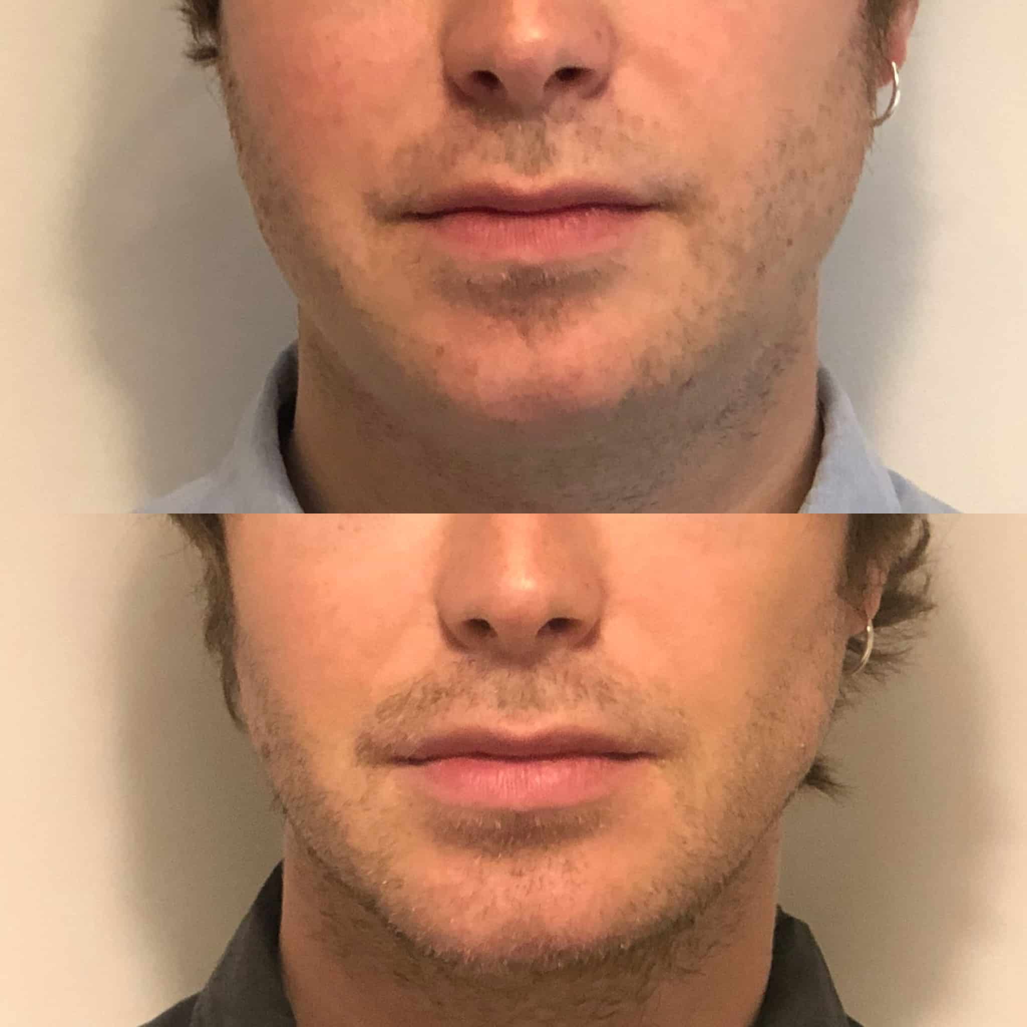 Antes y después de bichectomía en Barcelona, paciente 6