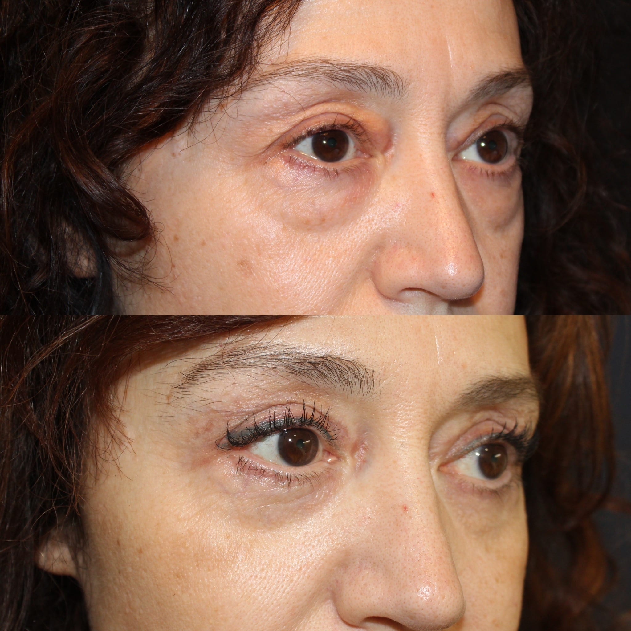 Antes y después de blefaroplastia en Barcelona, paciente 1