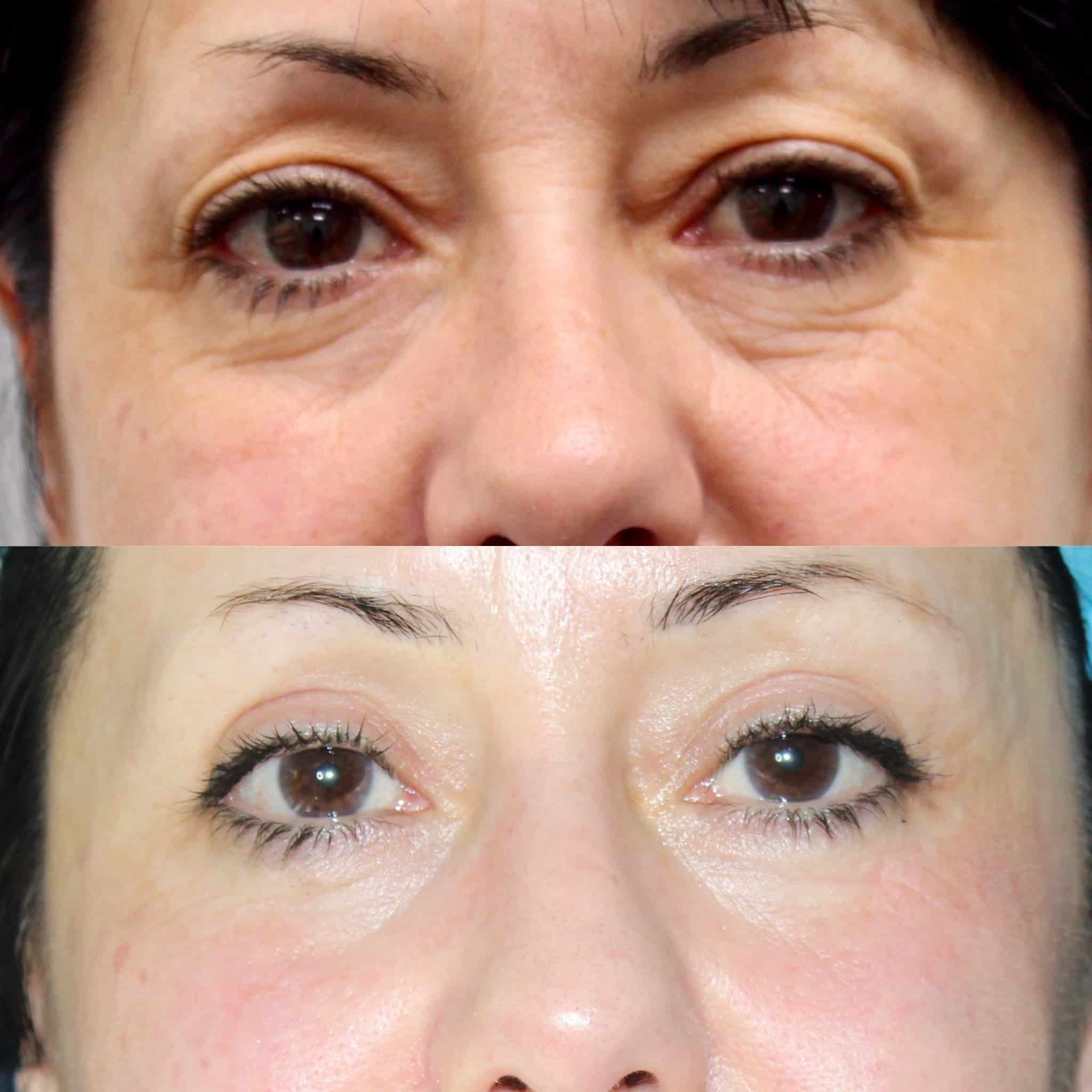 Antes y después de blefaroplastia en Barcelona, paciente 2
