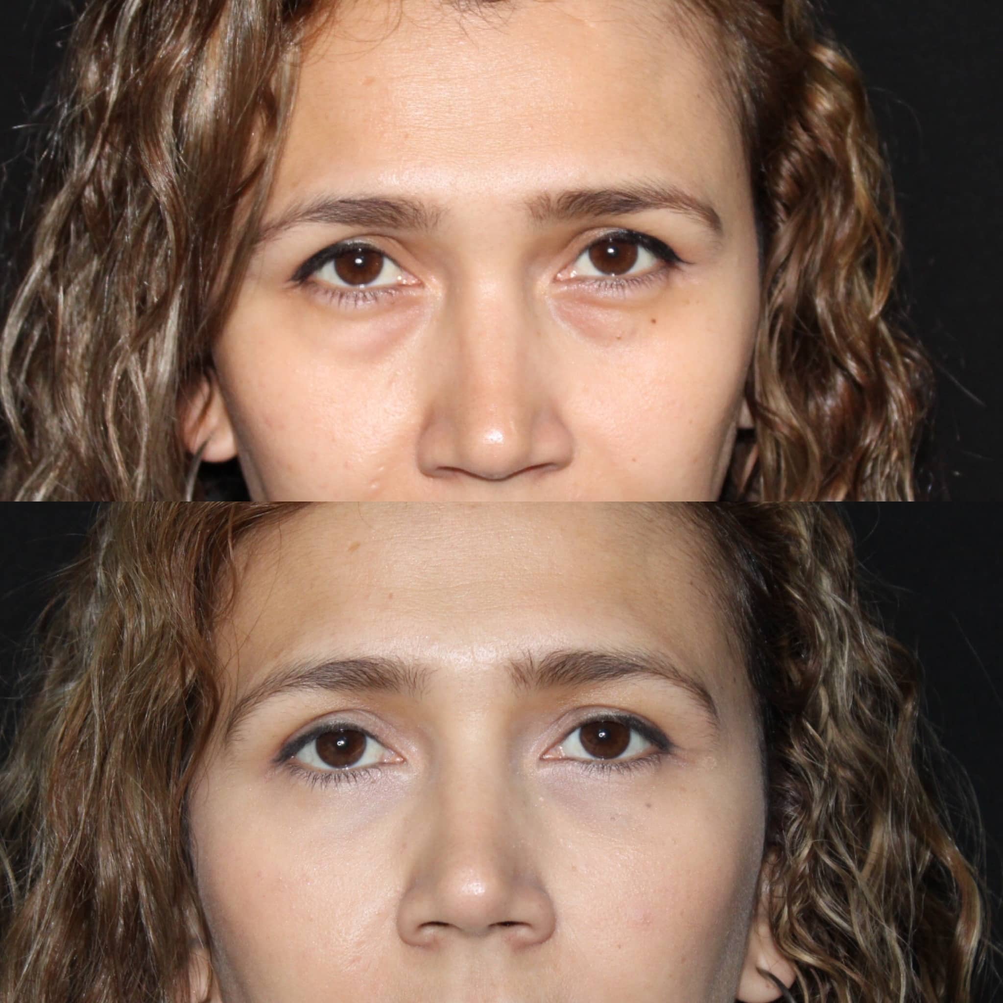 Antes y después de blefaroplastia en Barcelona, paciente 3