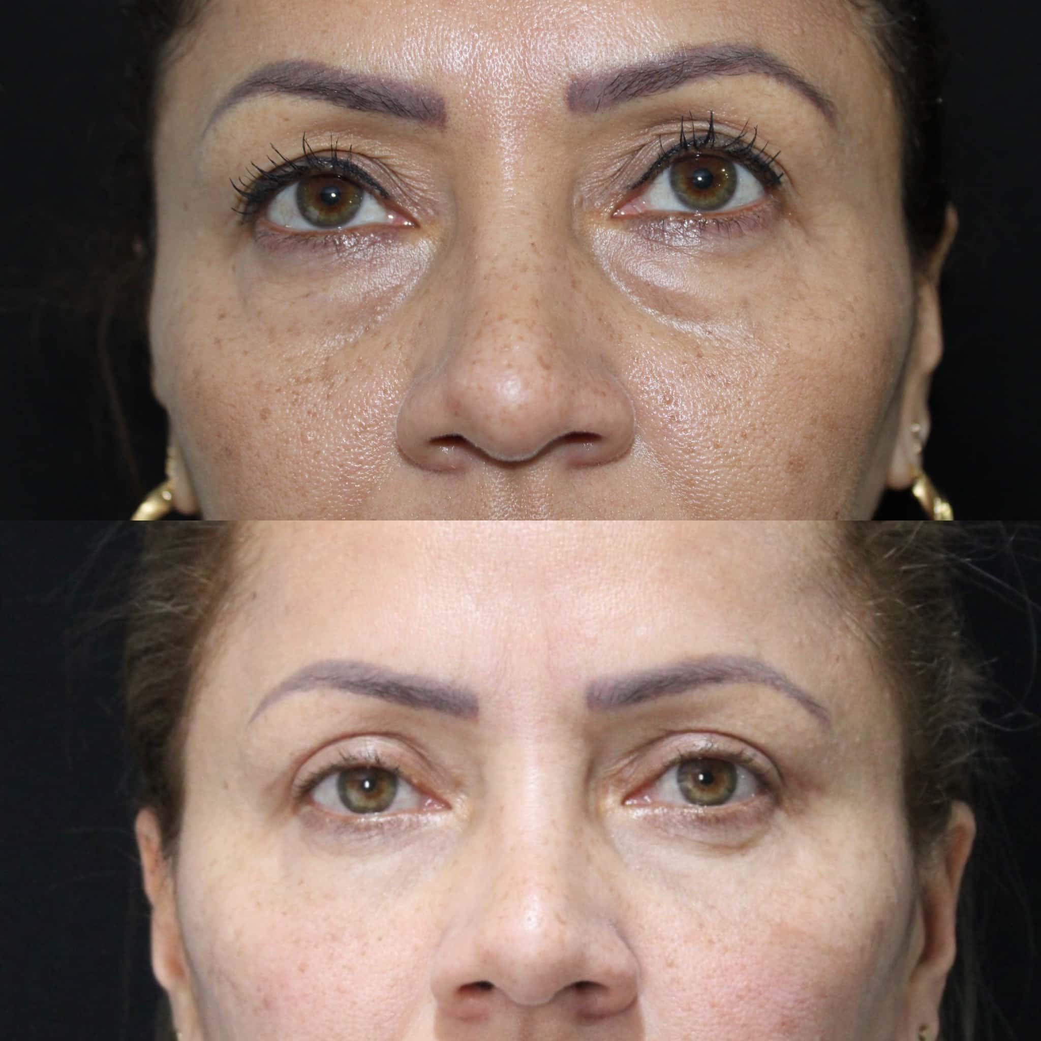 Antes y después de blefaroplastia en Barcelona, paciente 4