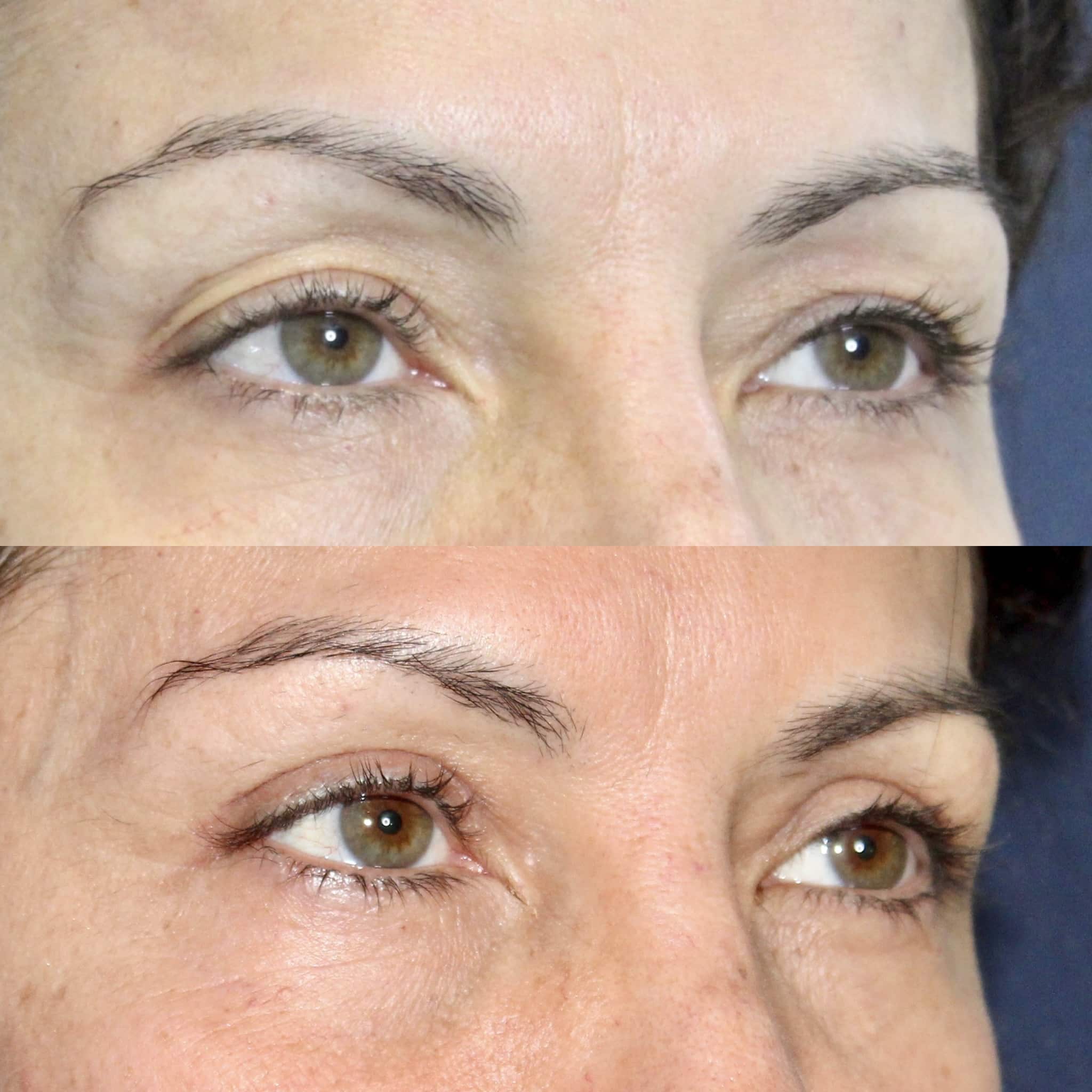 Antes y después de blefaroplastia en Barcelona, paciente 5