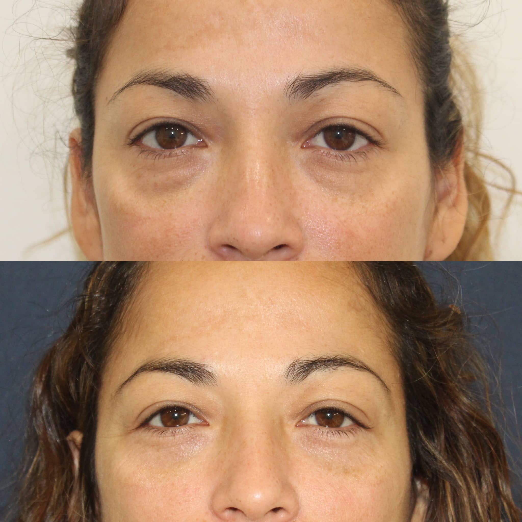 Antes y después de blefaroplastia en Barcelona, paciente 6