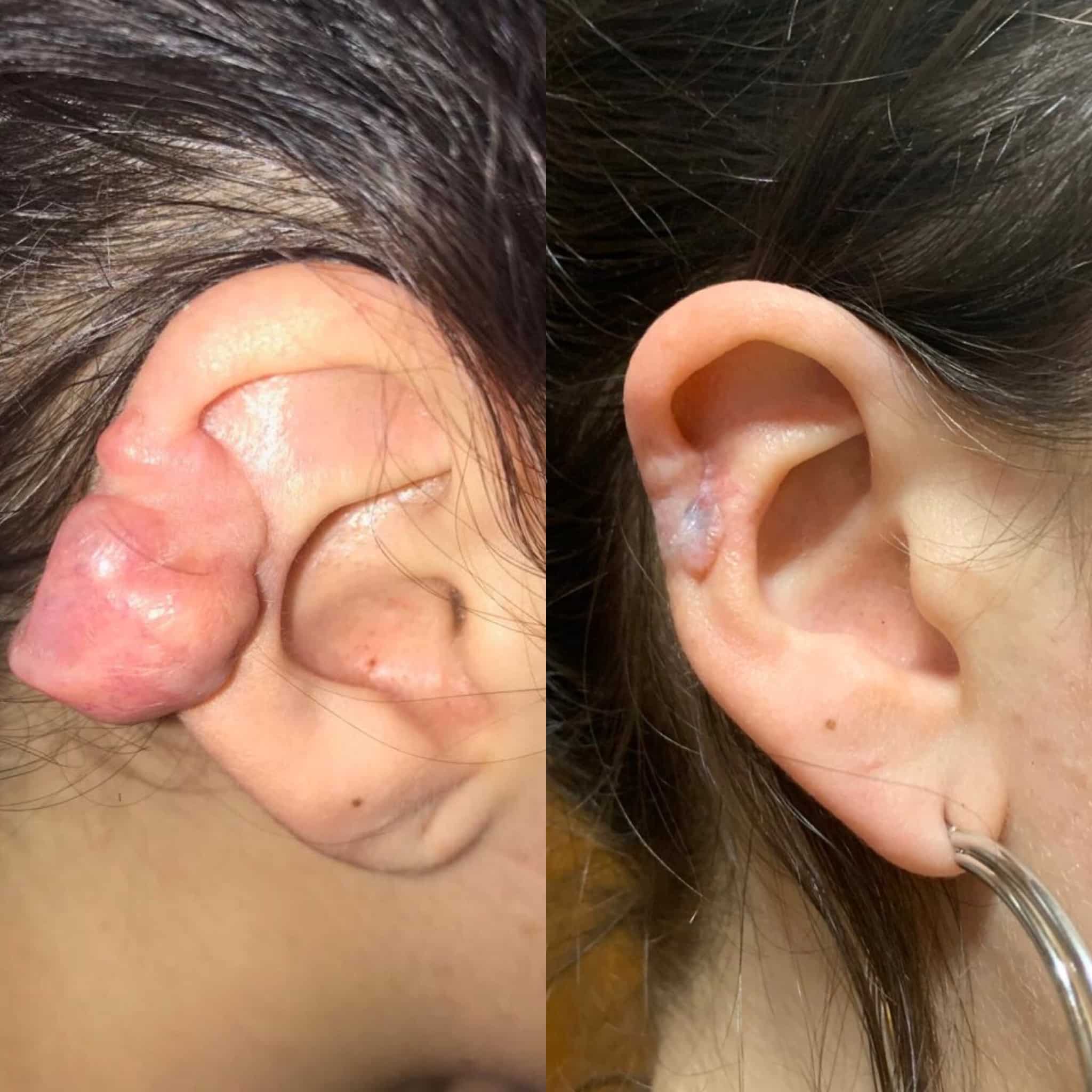Antes y después de tratamiento de cicatriz queloide en Barcelona, paciente 2