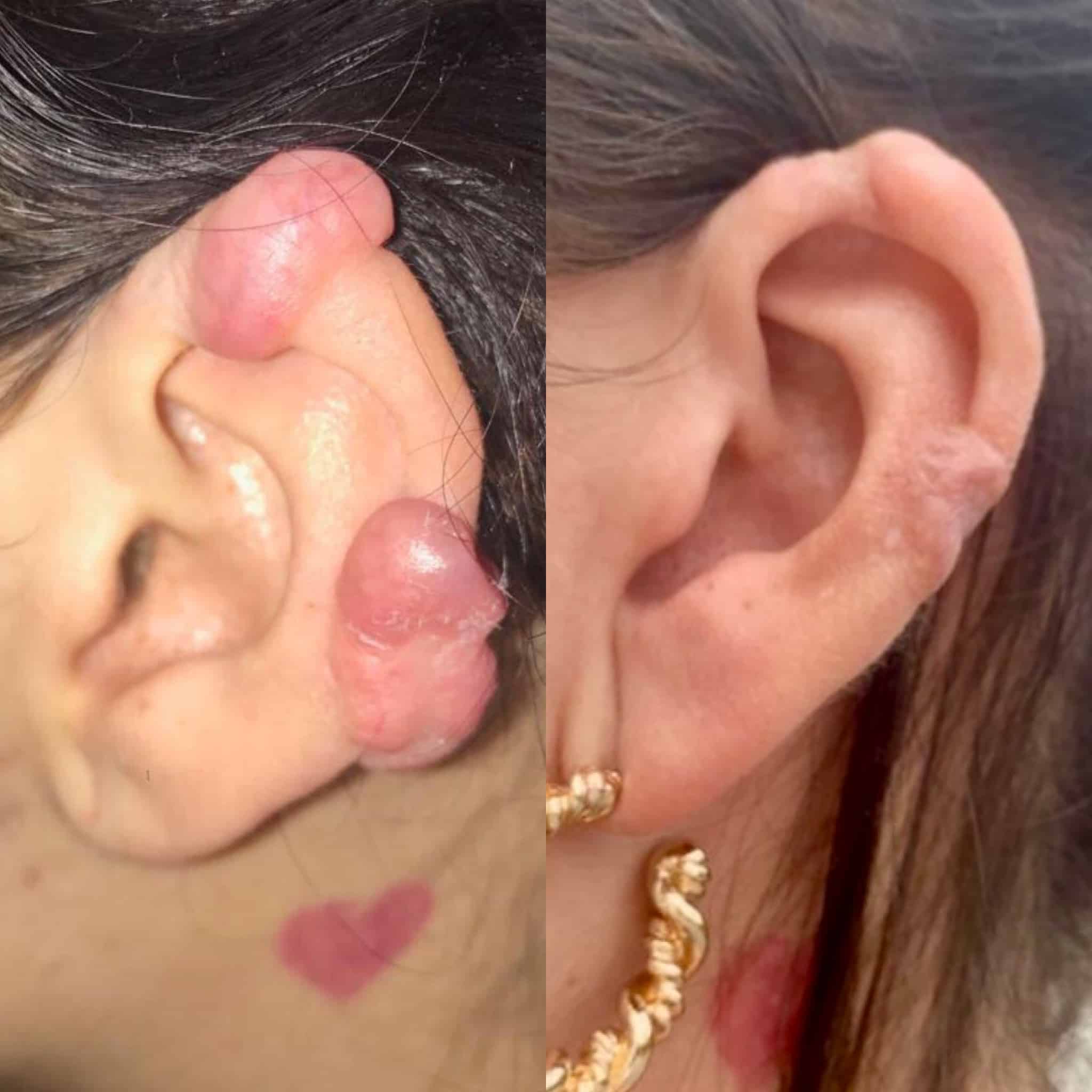 Antes y después de tratamiento de cicatriz queloide en Barcelona, paciente 3