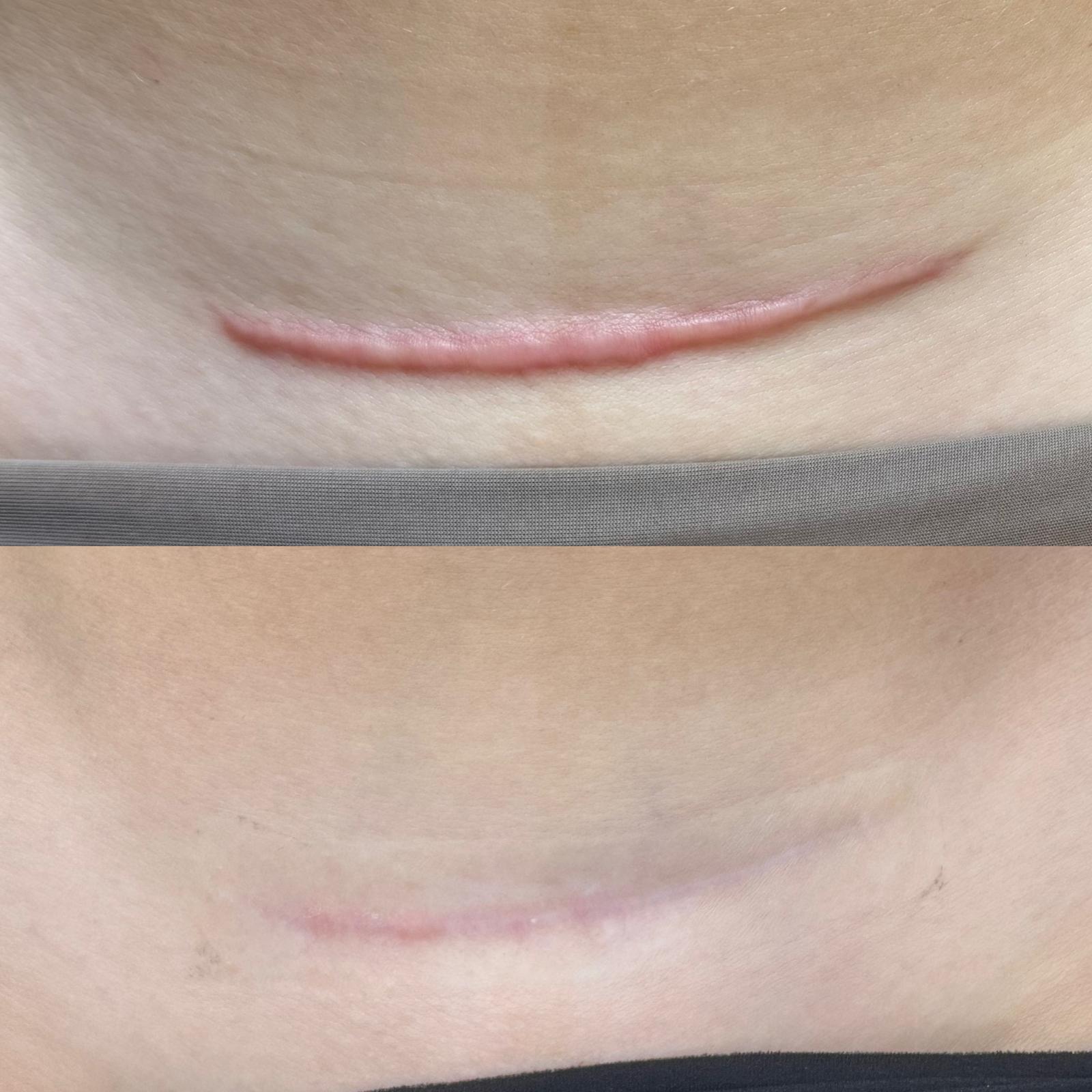 Antes y después de tratamiento de cicatriz hipertrófica abdominal en Barcelona