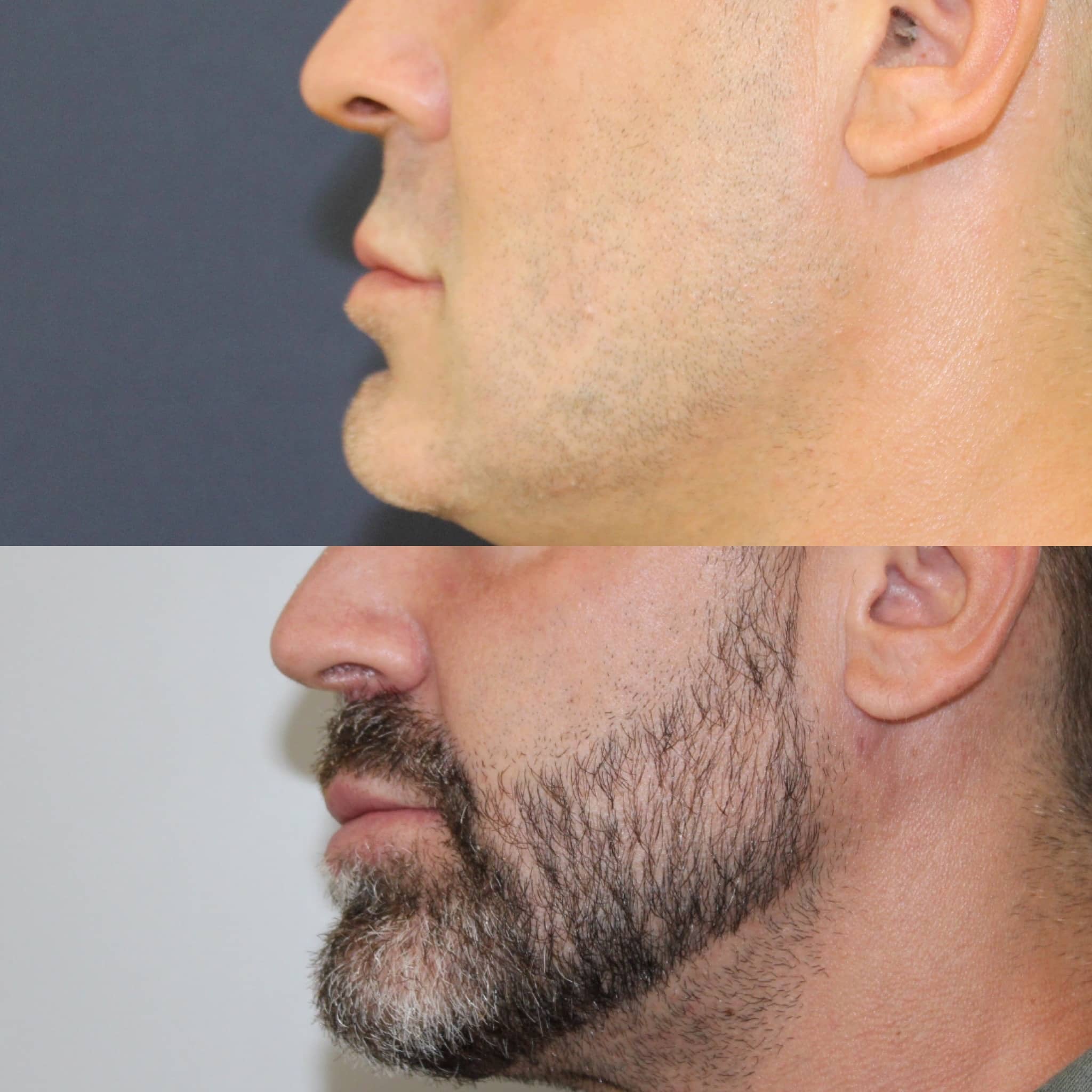 Antes y después de lip lift en Barcelona, paciente 1