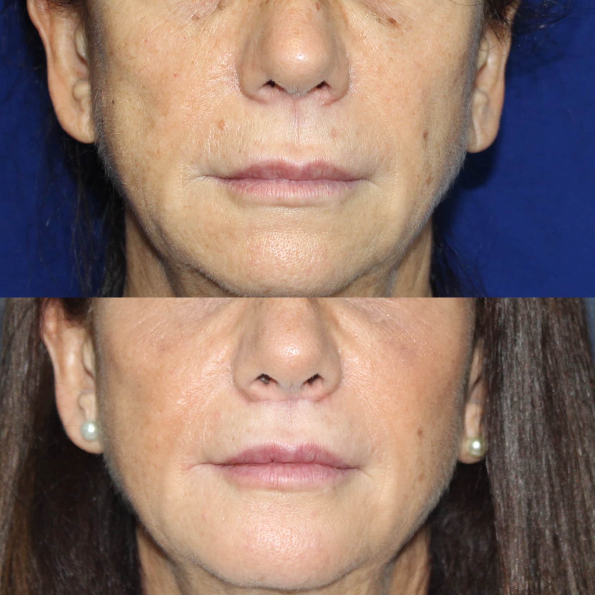 Antes y después de lip lift en Barcelona, paciente 2