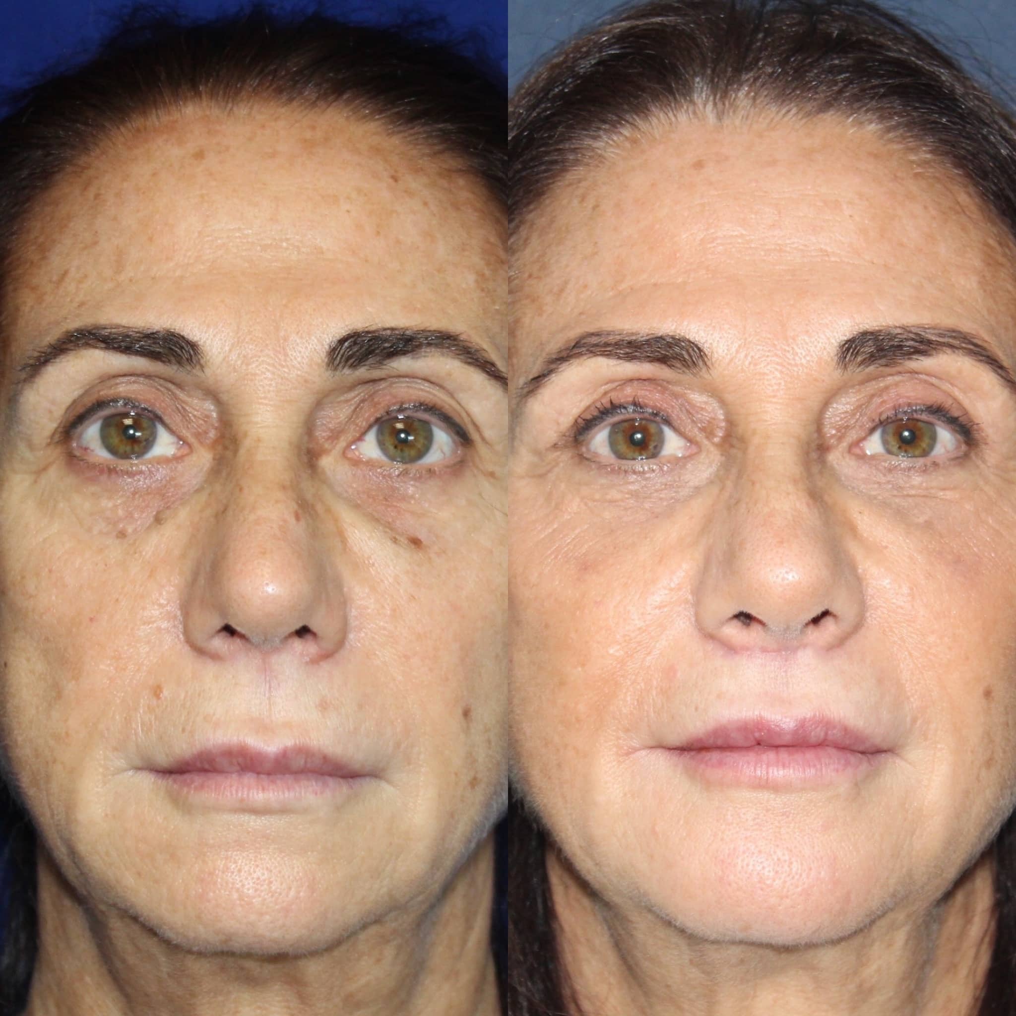 Antes y después de lip lift en Barcelona, perfil de boca