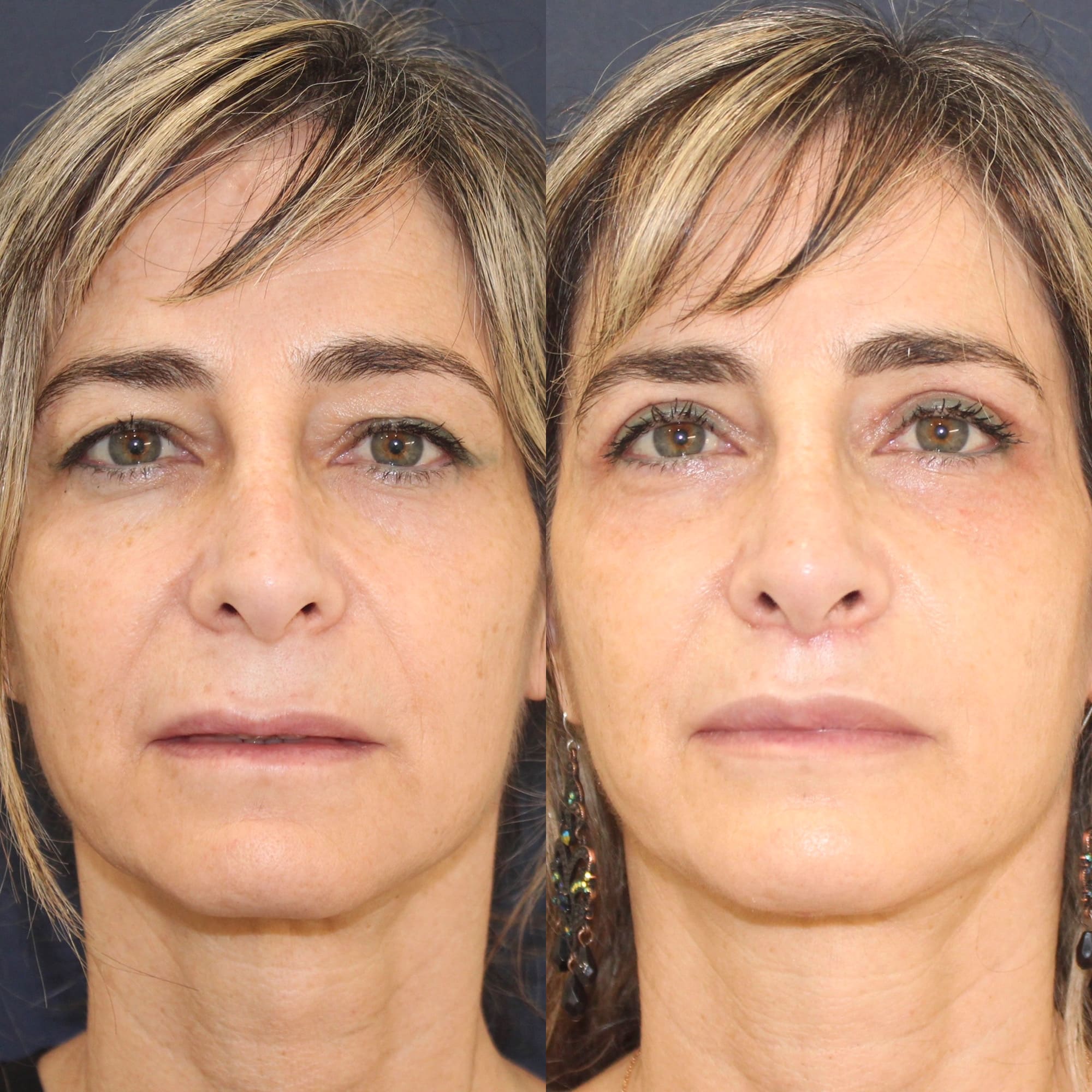 Antes y después de lip lift en Barcelona, rostro completo