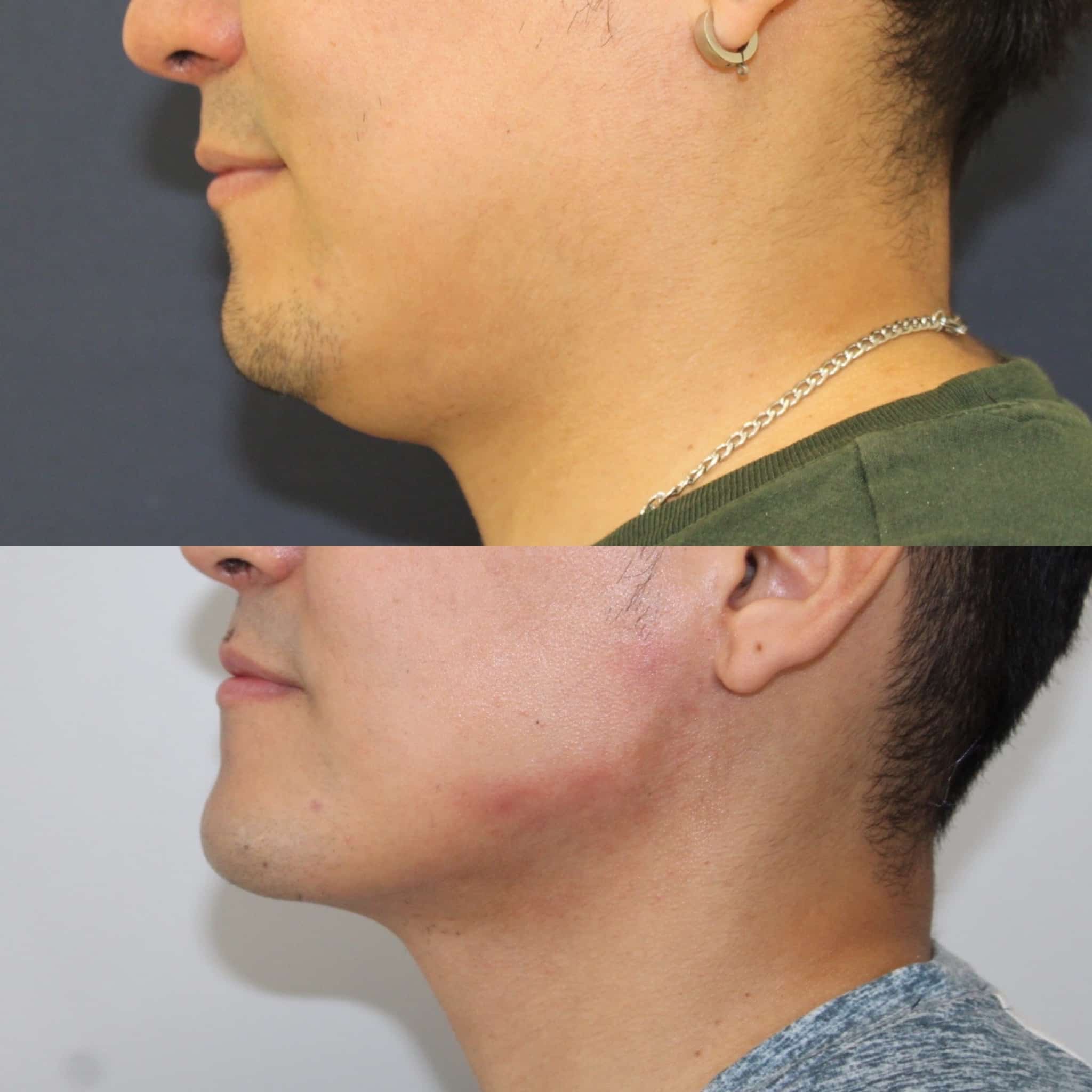 Antes y después de liposucción de papada en Barcelona, paciente 5
