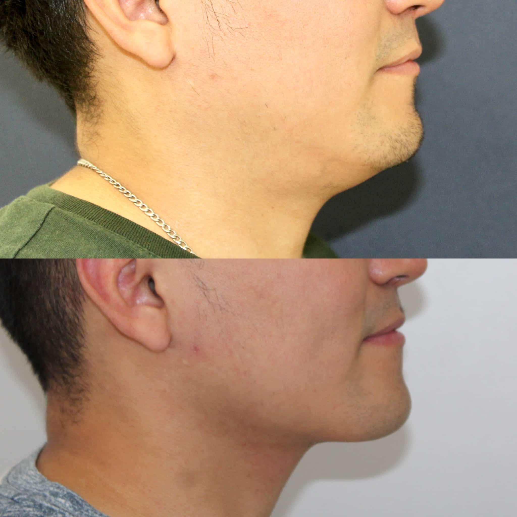 Antes y después de liposucción de papada en Barcelona, paciente 6