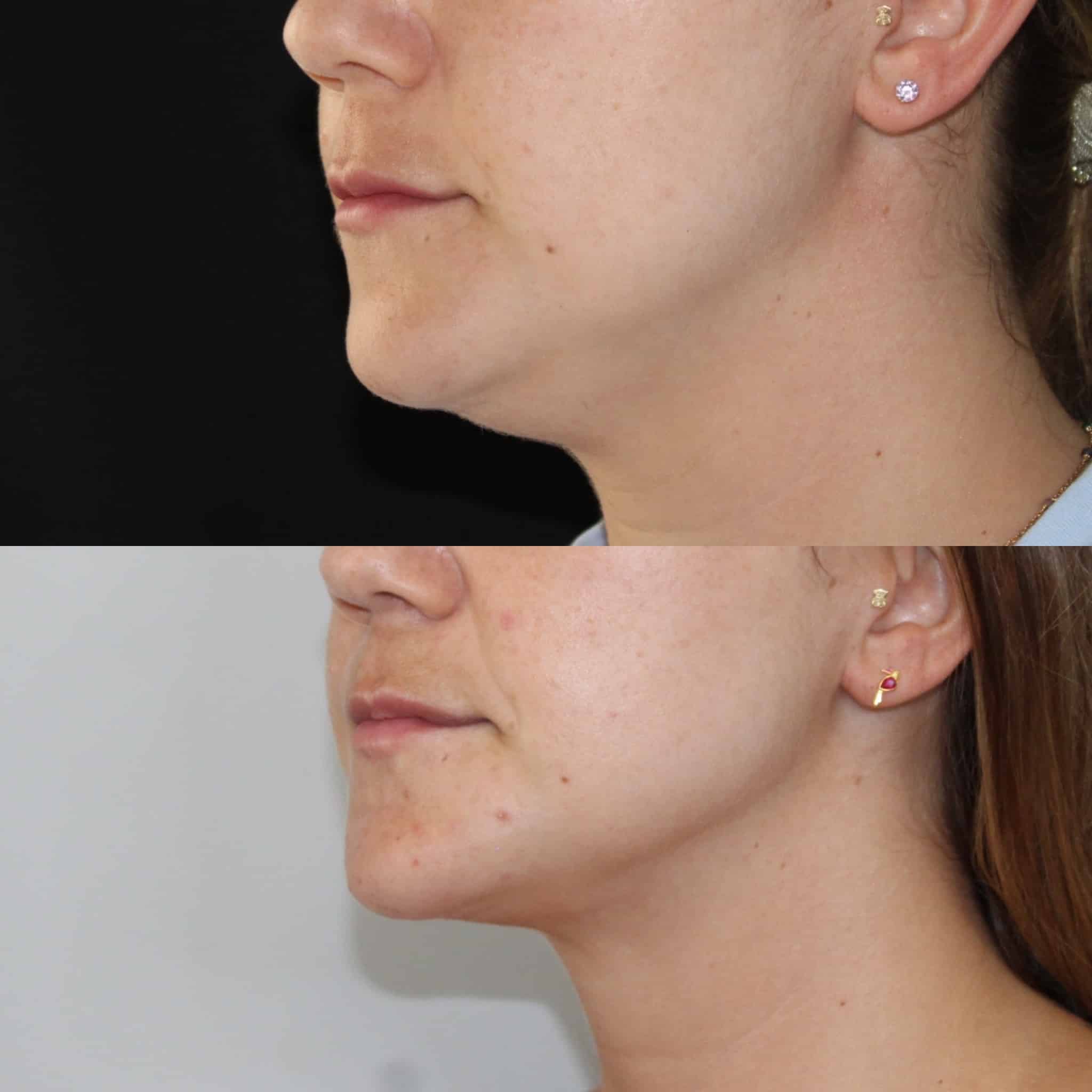 Antes y después de liposucción de papada en Barcelona, paciente 1