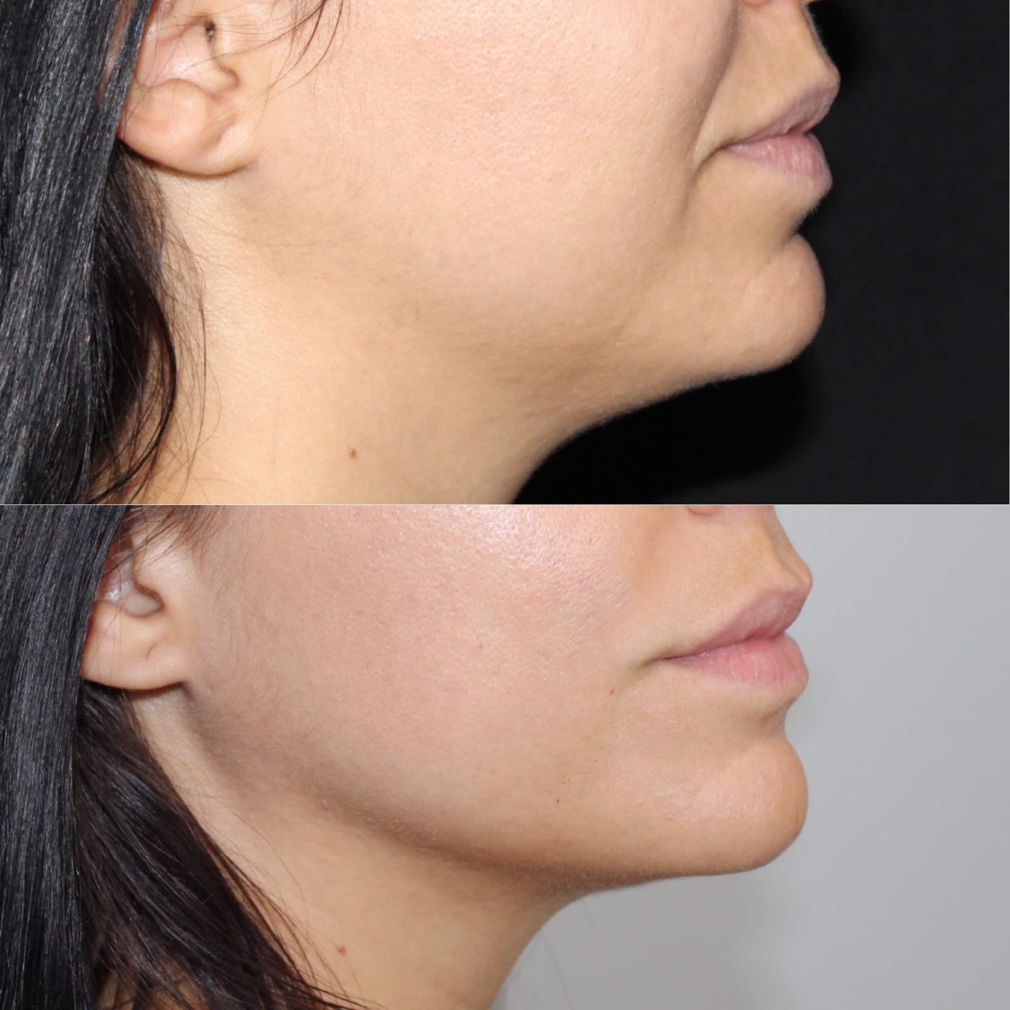 Antes y después de liposucción de papada en Barcelona, paciente 2