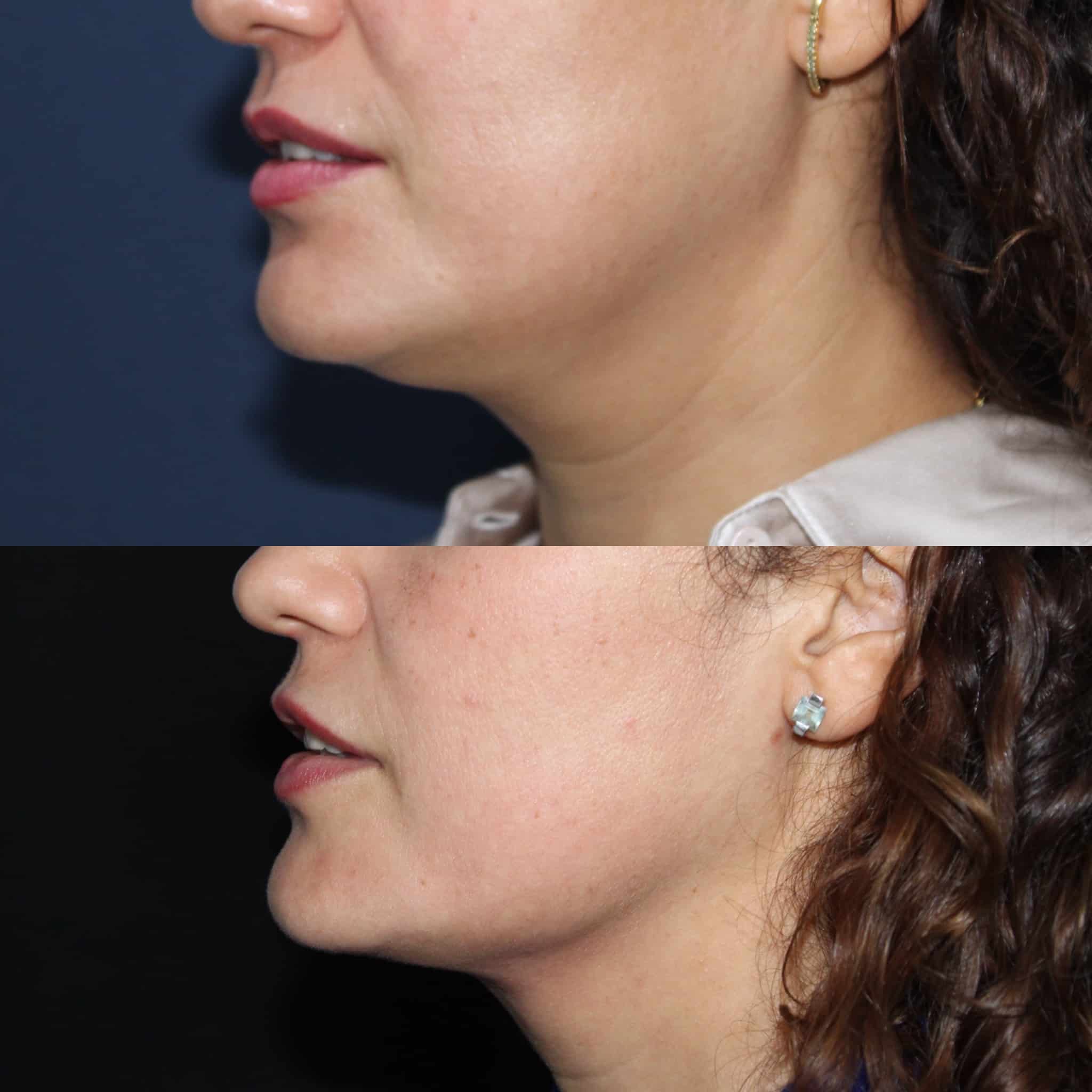 Antes y después de liposucción de papada en Barcelona, paciente 3
