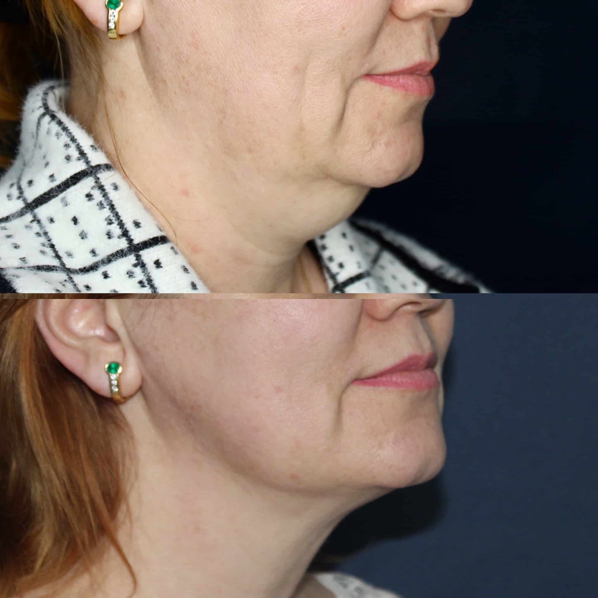 Antes y después de liposucción de papada en Barcelona, paciente 4