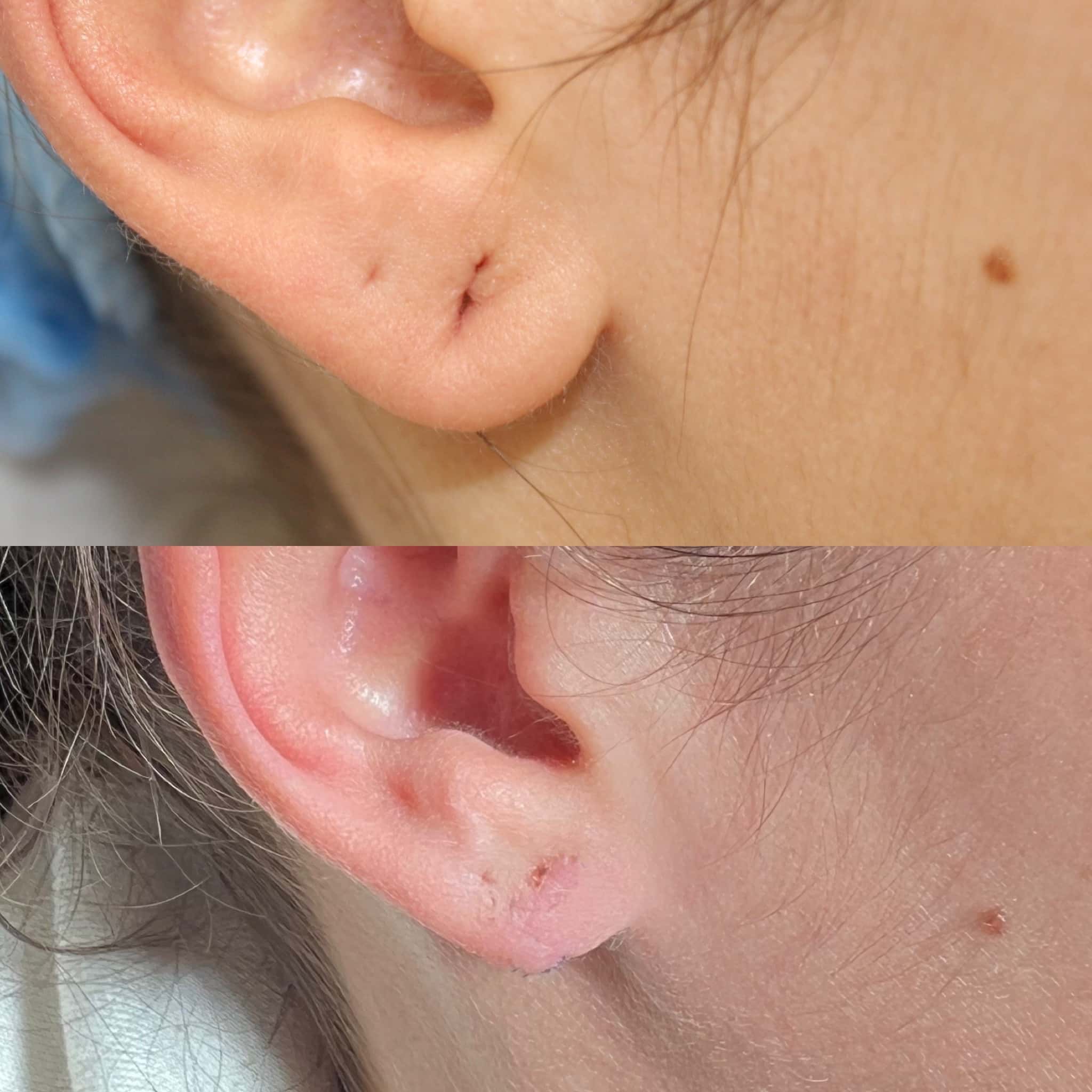 Antes y después de lobuloplastia en Barcelona, paciente 2
