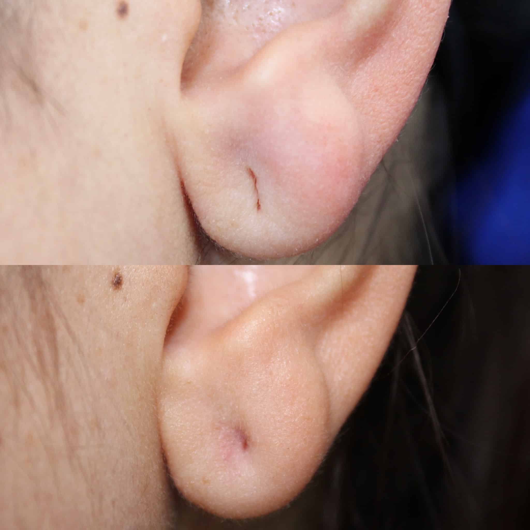 Antes y después de lobuloplastia en Barcelona, paciente 3