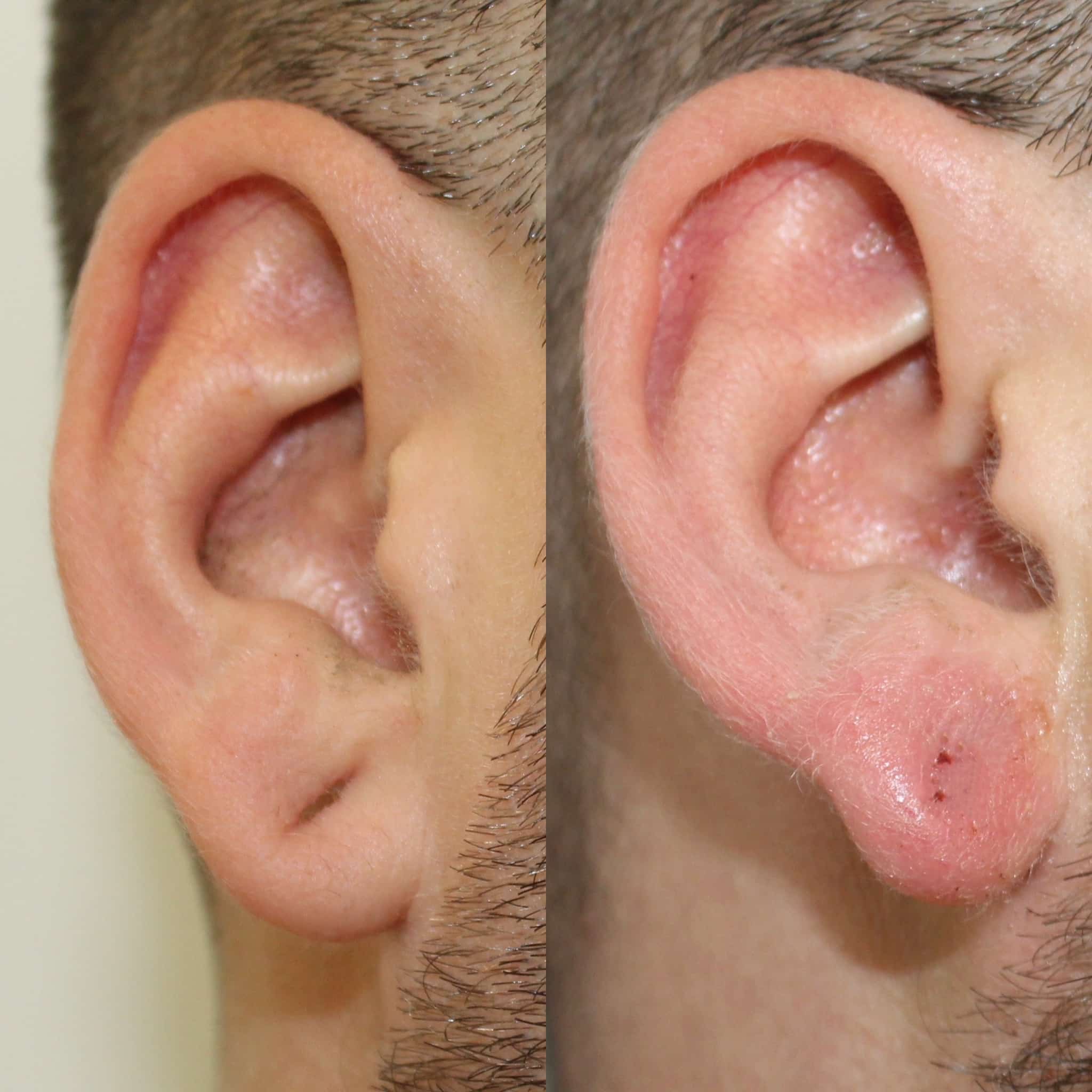 Antes y después de lobuloplastia en Barcelona, paciente 4