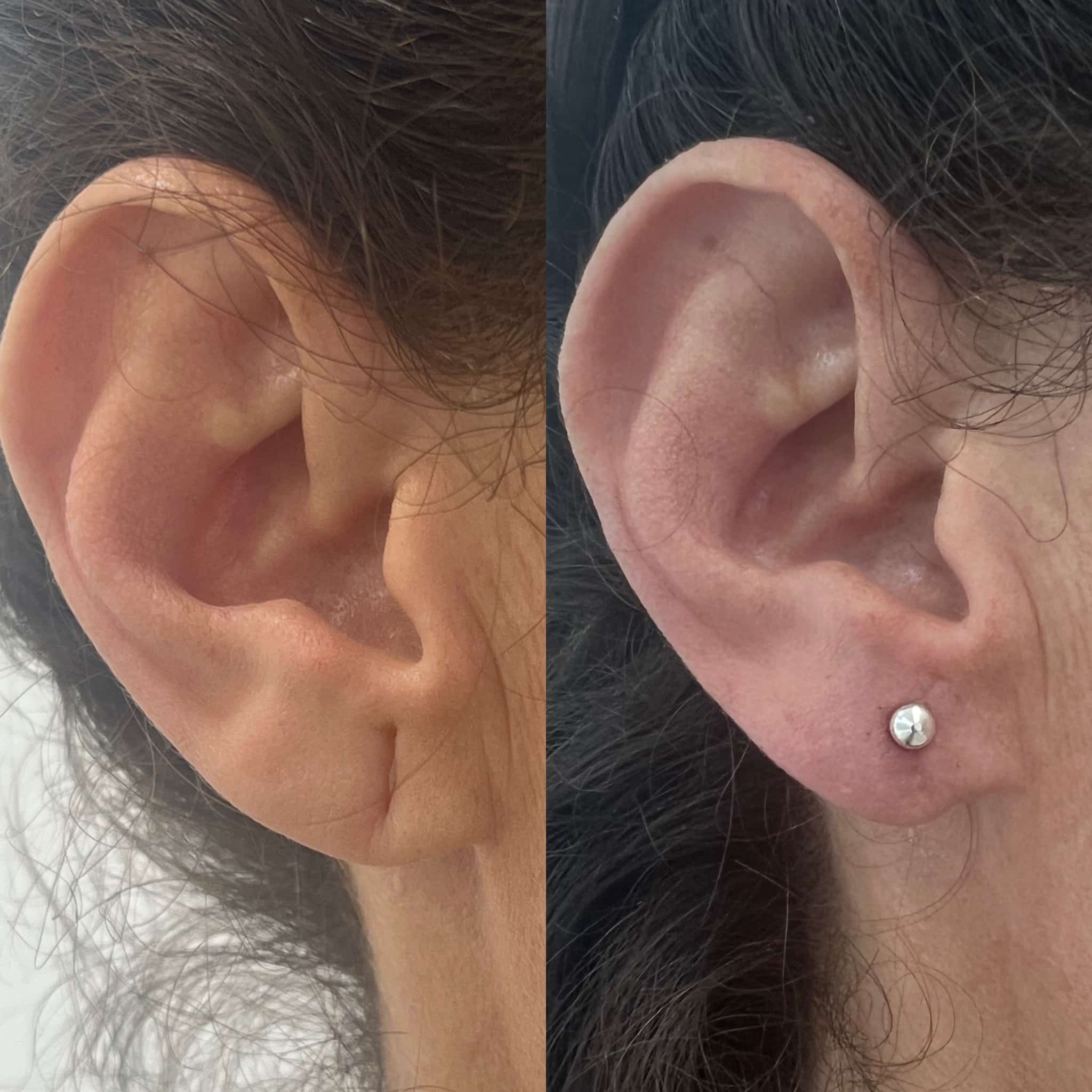 Antes y después de lobuloplastia en Barcelona, paciente 5