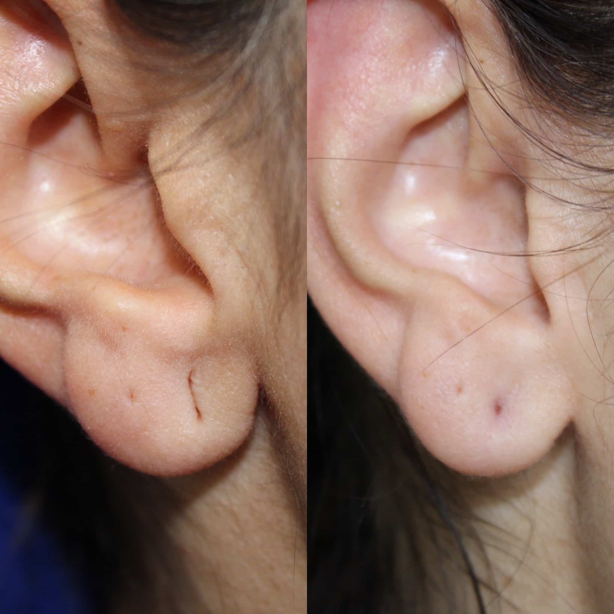 Antes y después de lobuloplastia en Barcelona, paciente 6