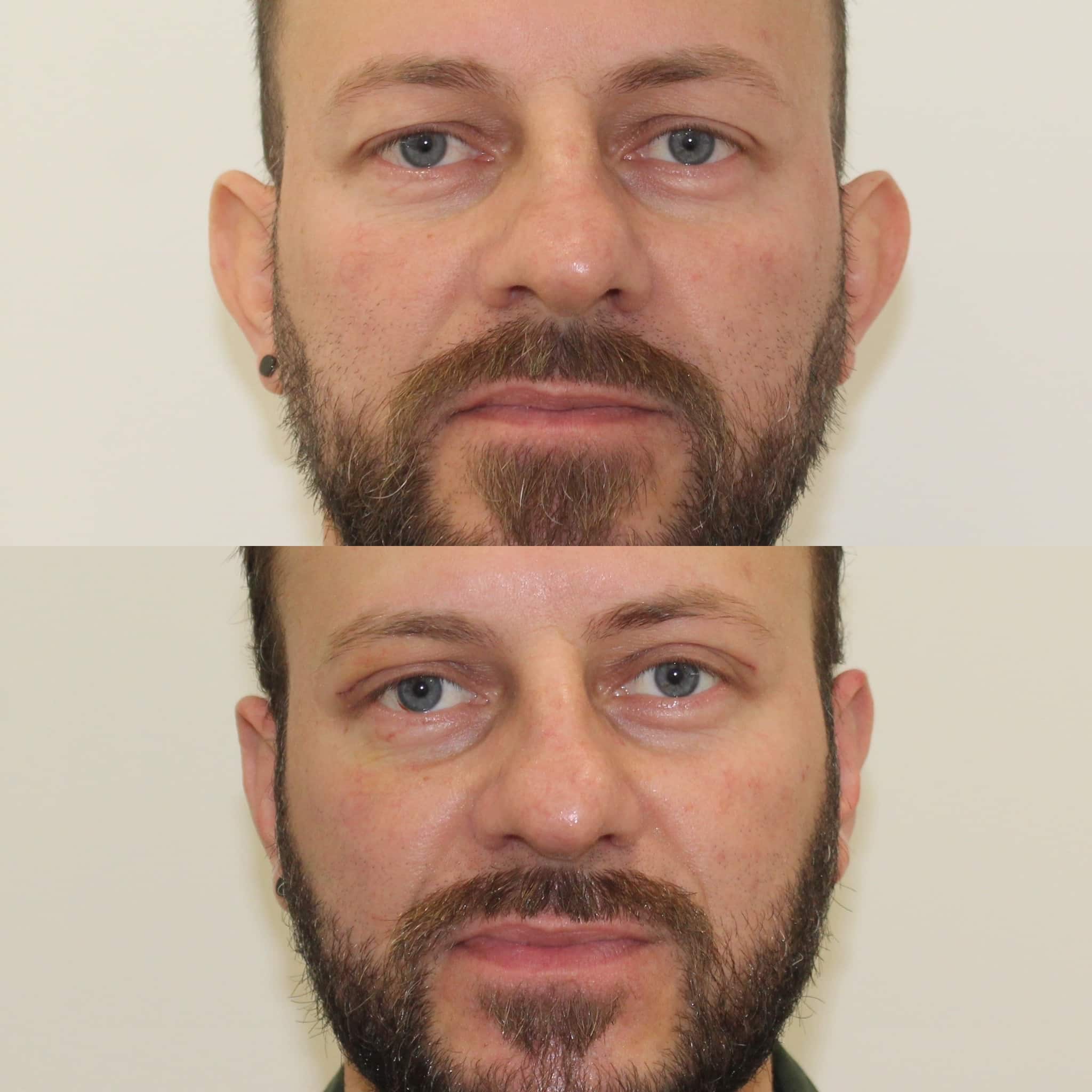 Antes y después de otoplastia en Barcelona, paciente 1