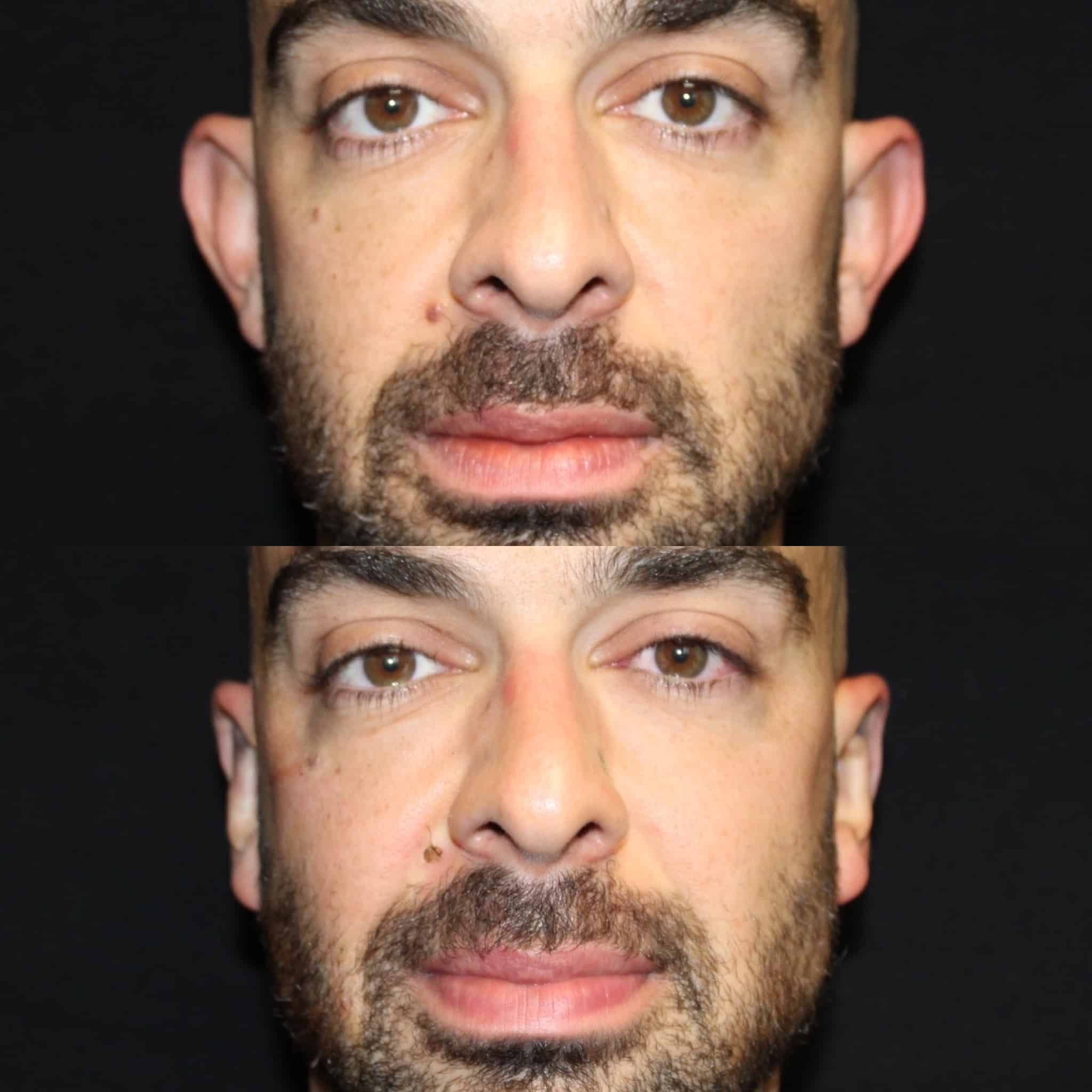 Antes y después de otoplastia en Barcelona, paciente 2