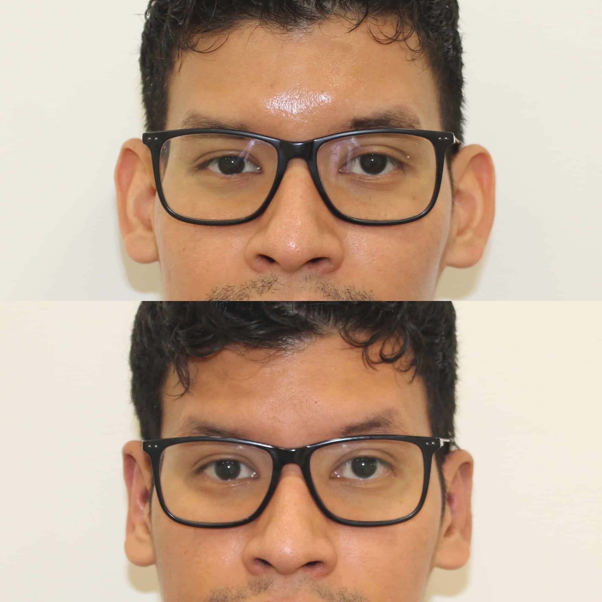 Antes y después de otoplastia en Barcelona, paciente 3