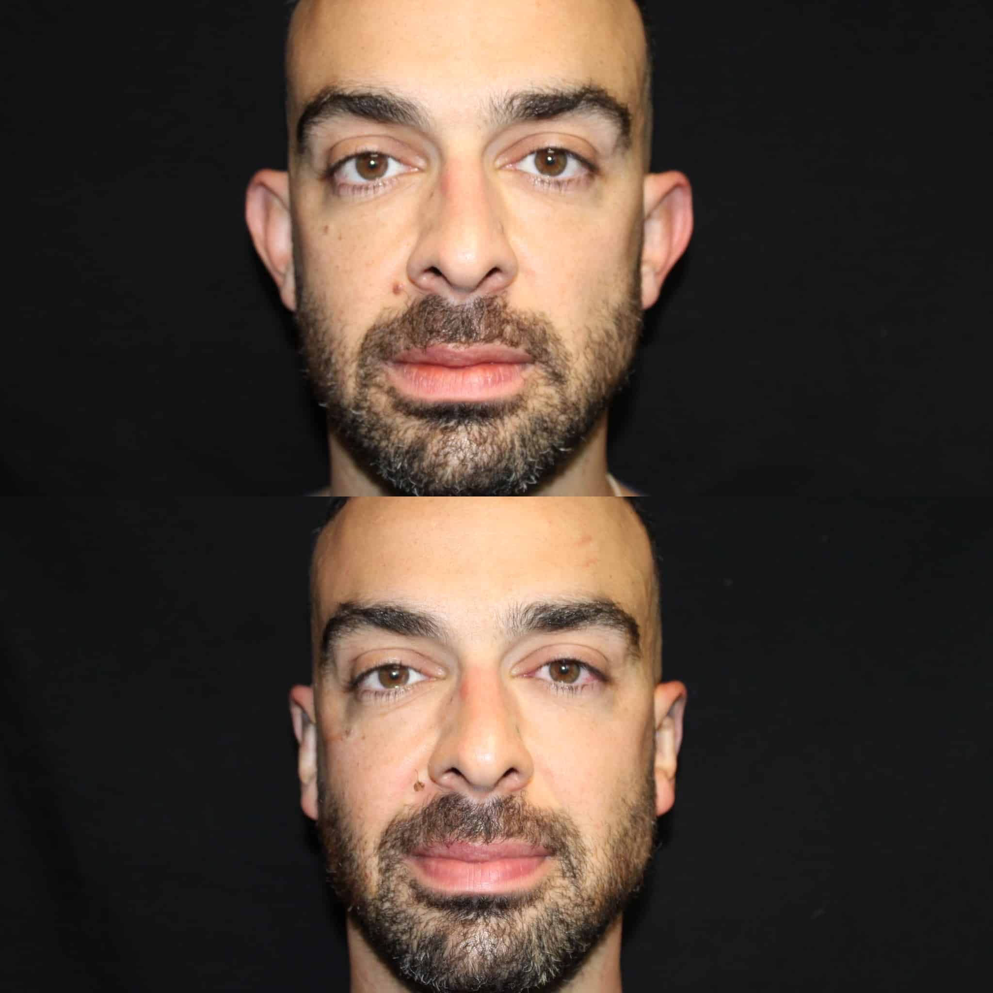 Antes y después de otoplastia en Barcelona, paciente 4