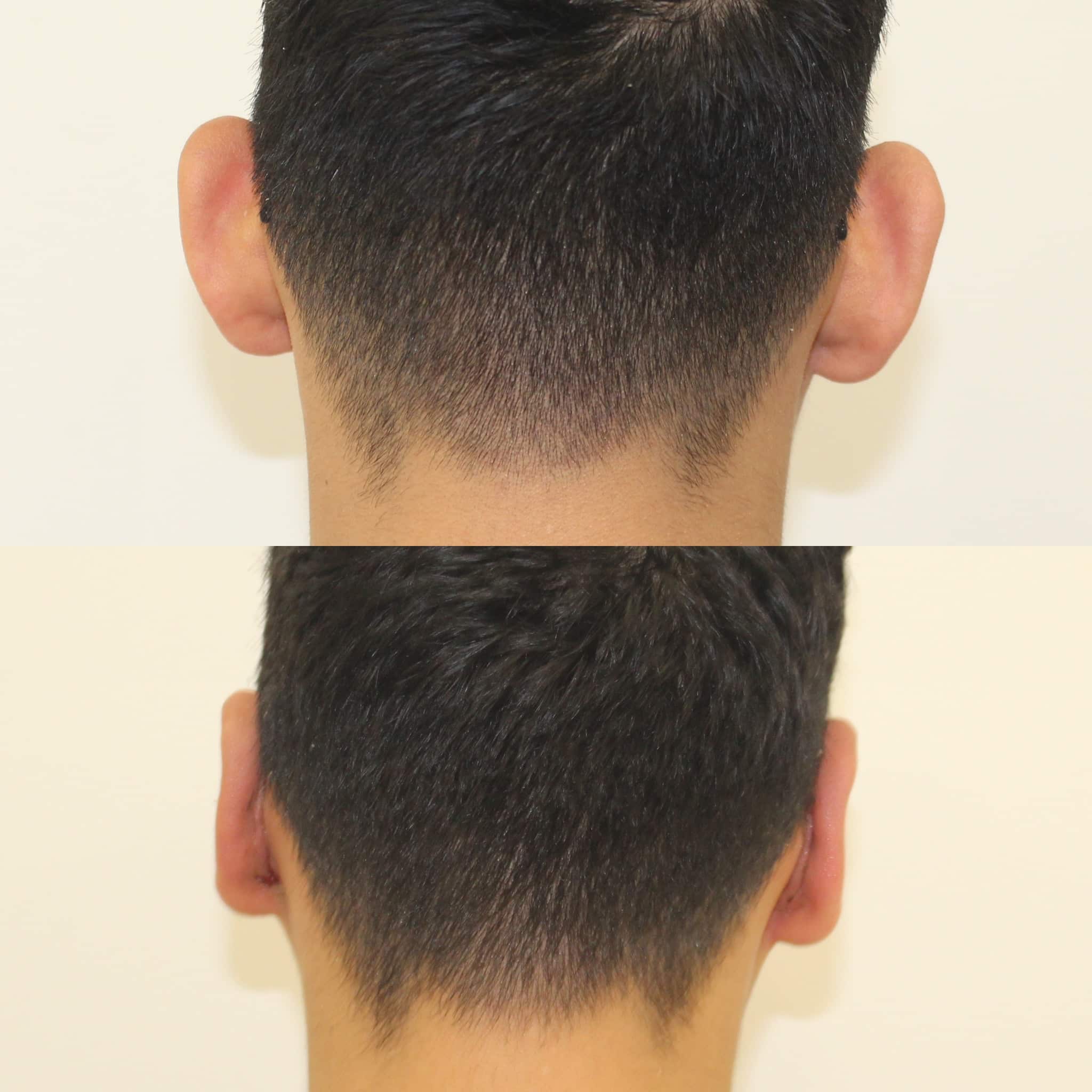Antes y después de otoplastia en Barcelona, vista de nuca, paciente 6