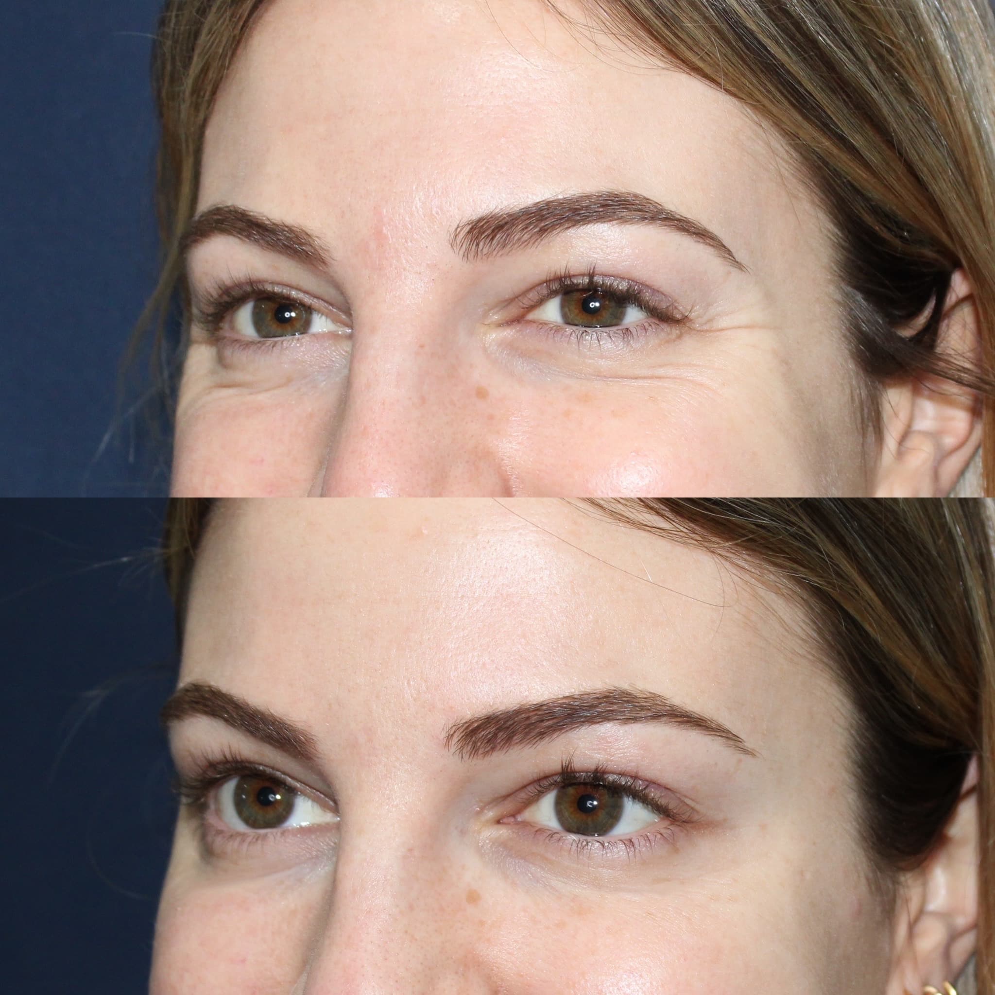 Antes y después de toxina botulínica tipo A en contorno de ojos, Barcelona, paciente 5